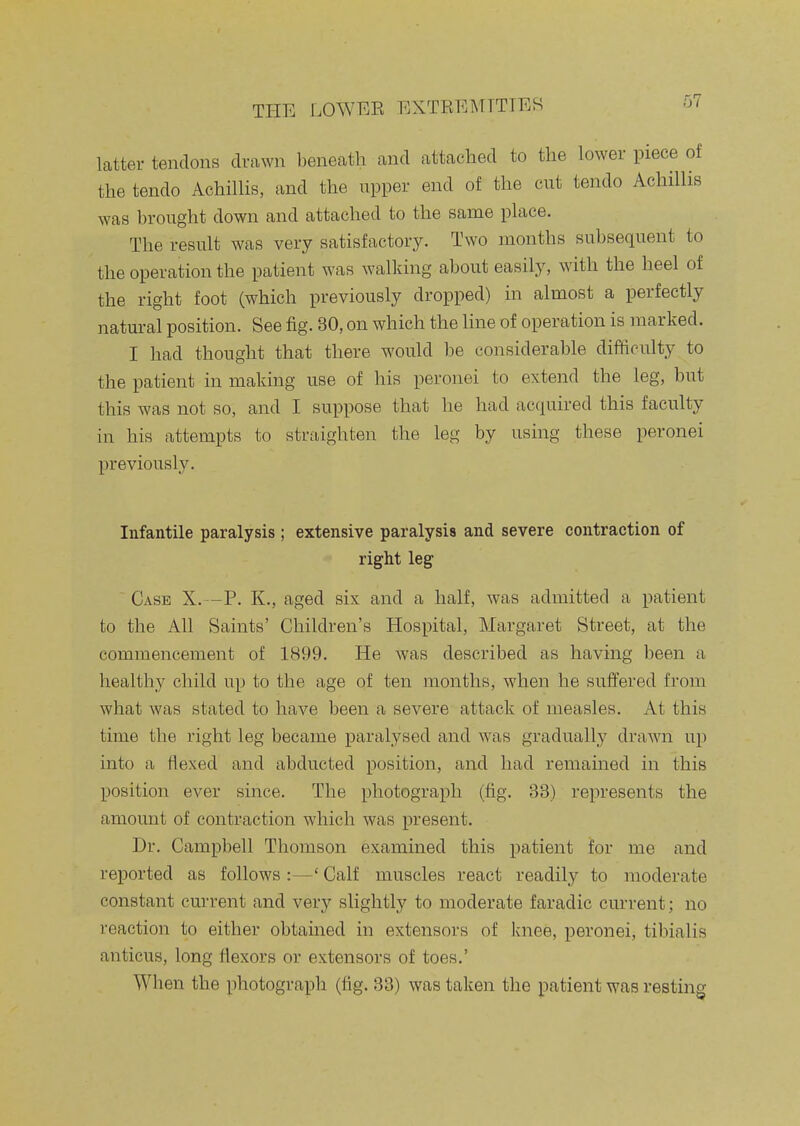latter tendons drawn beneath and attached to the lower piece of the tendo Achillis, and the upper end of the cut tendo Achillis was brought down and attached to the same place. The result was very satisfactory. Two months subsequent to the operation the patient was walking about easily, with the heel of the right foot (which previously dropped) in almost a perfectly natural position. See fig. 30, on which the line of operation is marked. I had thought that there would be considerable difficulty to the patient in making use of his peronei to extend the leg, but this was not so, and I suppose that he had acquired this faculty in his attempts to straighten the leg by using these peronei previously. Infantile paralysis; extensive paralysis and severe contraction of right leg ' Case X.—P. K., aged six and a half, was admitted a patient to the All Saints' Children's Hospital, Margaret Street, at the commencement of 1899. He was described as having been a healthy child up to the age of ten months, when he sufi^ered from what was stated to have been a severe attack of measles. At this time the right leg became paralysed and was gradually drawn up into a flexed and abducted position, and had remained in this position ever since. The photograph (tig. 33) represents the amount of contraction which was present. Dr. Campbell Thomson examined this patient for me and reported as follows :—' Calf muscles react readily to moderate constant current and very slightly to moderate faradic current; no reaction to either obtained in extensors of laiee, peronei, tibialis anticus, long flexors or extensors of toes.' When the photograpli (fig. 33) was taken tlie patient was resting