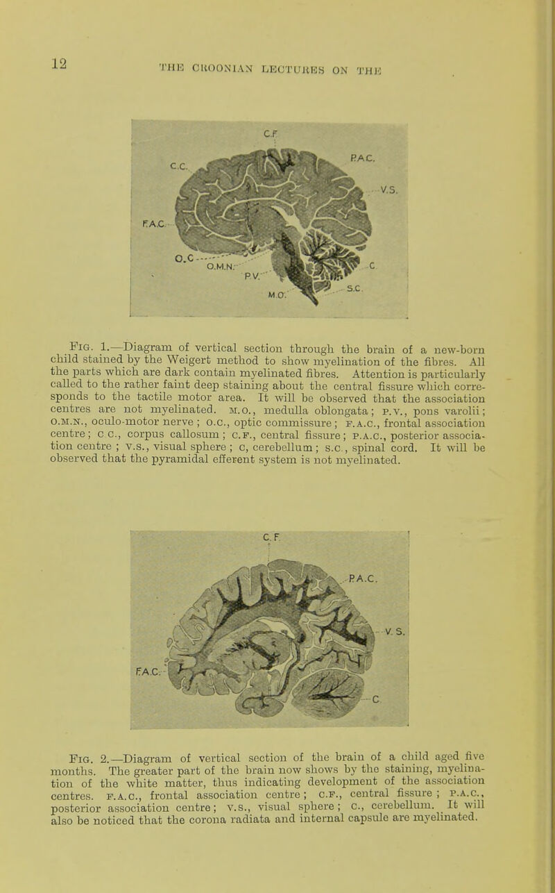 THE CICO0N1AN LBOTUJftBS ON THIi Pig. 1.—Diagram of vertical section through the brain of a new-born child stained by the Weigert method to show myelination of the fibres. All the parts which are dark contain myelinated fibres. Attention is particularly called to the rather faint deep staining about the central fissure which corre- sponds to the tactile motor area. It will be observed that the association centres are not myelinated, m.o., medulla oblongata; p. v., pons varolii; o.m.n., oculo-motor nerve ; o.c, optic commissure ; p.a.c, frontal association centre; c c, corpus callosum; c.f., central fissure; p.a.c, posterior associa- tion centre ; v.s., visual sphere ; c, cerebellum; s.c, spinal cord. It will be observed that the pyramidal efferent system is not myelinated. Fig. 2.—Diagram of vertical section of the brain of a child aged five months. The greater part of the brain now shows by the staining, myelina- tion of the white matter, thus indicating development of the association centres, f.a.c, frontal association centre; c.f., central fissure; p.a.c., posterior association centre; v.s., visual sphere; c, cerebellum. It will also be noticed that the corona radiata and internal capsule are myelinated.