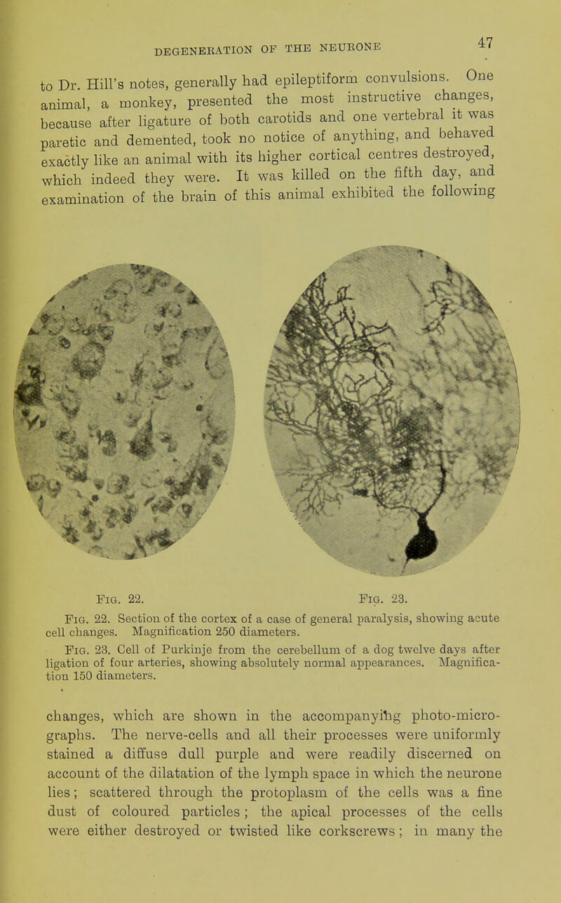 to Dr Hill's notes, generally had epileptiform convulsions. One animal, a monkey, presented the most instructive changes, because after ligature of both carotids and one vertebral it was paretic and demented, took no notice of anything, and behaved exactly like an animal with its higher cortical centres destroyed, which indeed they were. It was killed on the fifth day, and examination of the brain of this animal exhibited the following Fig. 22. Fig. 23. Fig. 22. Section of the cortex of a case of general paralysis, showing acute cell changes. Magnification 250 diameters. Fig. 23. Cell of Purkinje from the cerebellum of a dog twelve days after ligation of four arteries, showing absolutely normal appearances. Magnifica- tion 150 diameters. changes, which are shown in the accompanying photo-micro- graphs. The nerve-cells and all their processes were uniformly stained a diffuse dull purple and were readily discerned on account of the dilatation of the lymph space in which the neurone lies; scattered through the protoplasm of the cells was a fine dust of coloured particles; the apical processes of the cells were either destroyed or twisted like corkscrews; in many the