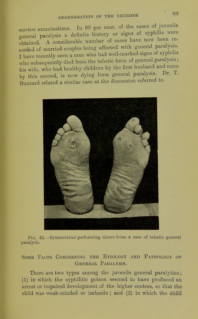 mortem examinations. Ia 80 per cent, of the cases of juvenile general paralysis a definite history or signs of syphilis were obtained. A considerable number of cases have now been re- corded of married couples being affected with general paralysis. I have recently seen a man who had well-marked signs of syphilis who subsequently died from the tabetic form of general paralysis; his wife, who had healthy children by the first husband and none by this second, is now dying from general paralysis. Dr. T. Buzzard related a similar case at the discussion referred to. Pig. 42.—Symmetrical perforating ulcers from a. case of tabetic general paralysis. Some Facts Concerning the Etiology and Pathology ob' General Paralysis. There are two types among the juvenile general paralytics; (1) in which the syphilitic poison seemed to have produced an arrest or impaired development of the higher centres, so that the child was weak-minded or imbecile ; and (2) in which the child