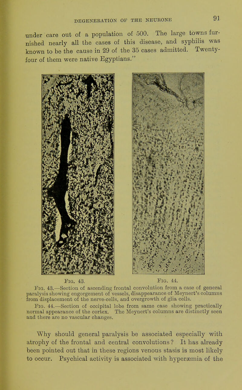 under care out of a population of 500. The large towns fur- nished nearly all the cases of this disease, and syphilis was known to be the cause in 29 of the 35 cases admitted. Twenty- four of them were native Egyptians. Pig. 43. Fig. 44. Fig. 43.—Section of ascending frontal convolution from a case of general paralysis showing engorgement of vessels, disappearance of Meynert's columns from displacement of the nerve-cells, and overgrowth of glia cells. Fig. 44.—Section of occipital lohe from same case showing practically normal appearance of the cortex. The Meynert's columns are distinctly seen and there are no vascular changes. Why should general paralysis be associated especially with atrophy of the frontal and central convolutions ? It has already been pointed out that in these regions venous stasis is most likely to occur. Psychical activity is associated with hyperemia of the