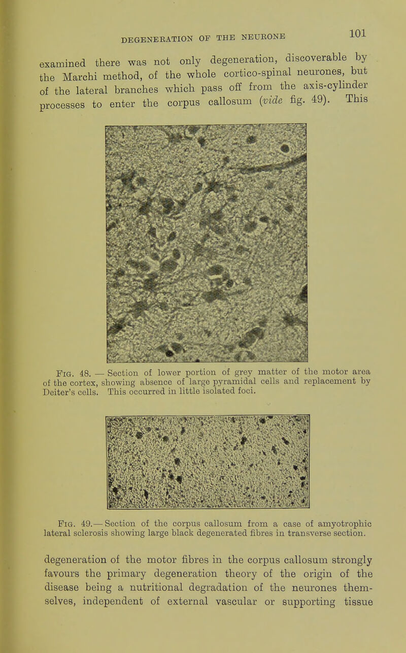 examined there was not only degeneration, discoverable by the Marchi method, of the whole cortico-spinal neurones, but of the lateral branches which pass off from the axis-cylinder processes to enter the corpus callosum (vide fig. 49). This Fig. 48. — Section of lower portion of grey matter of the motor area of the cortex, showing ahsence of large pyramidal cells and replacement by Deiter's cells. This occurred in little isolated foci. Fig. 49.— Section of the corpus callosum from a case of amyotrophic lateral sclerosis showing large black degenerated fibres in transverse section. degeneration of the motor fibres in the corpus callosum strongly favours the primary degeneration theory of the origin of the disease being a nutritional degradation of the neurones them- selves, independent of external vascular or supporting tissue