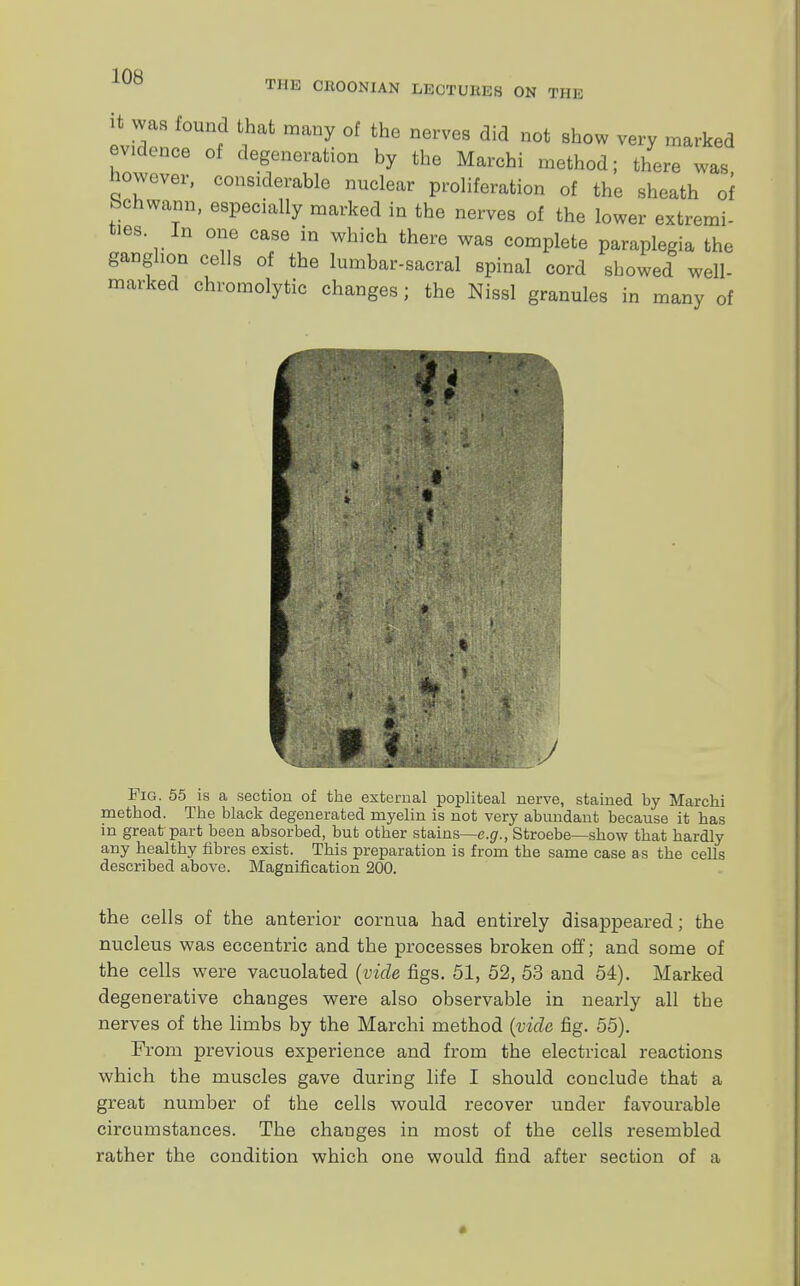THE CROONIAN LECTUHE8 ON THE i was found that many of the nerves did not show very marked evince of degeneration by the Marchi method; there was however, considerable nuclear proliferation of the sheath of Schwann, especially marked in the nerves of the lower extremi- ties In one case in which there was complete paraplegia the ganglion cells of the lumbar-sacral spinal cord showed well- marked chromolytic changes; the Nissl granules in many of if Fig. 55 is a section of the external popliteal nerve, stained by Marchi method. The black degenerated myelin is not very abundant because it has m great part been absorbed, but other stains—e.g., Stroebe—show that hardly any healthy fibres exist. This preparation is from the same case as the cells described above. Magnification 200. the cells of the anterior cornua had entirely disappeared; the nucleus was eccentric and the processes broken off; and some of the cells were vacuolated (vide figs. 51, 52, 53 and 54). Marked degenerative changes were also observable in nearly all the nerves of the limbs by the Marchi method (vide fig. 55). From previous experience and from the electrical reactions which the muscles gave during life I should conclude that a great number of the cells would recover under favourable circumstances. The changes in most of the cells resembled rather the condition which one would find after section of a