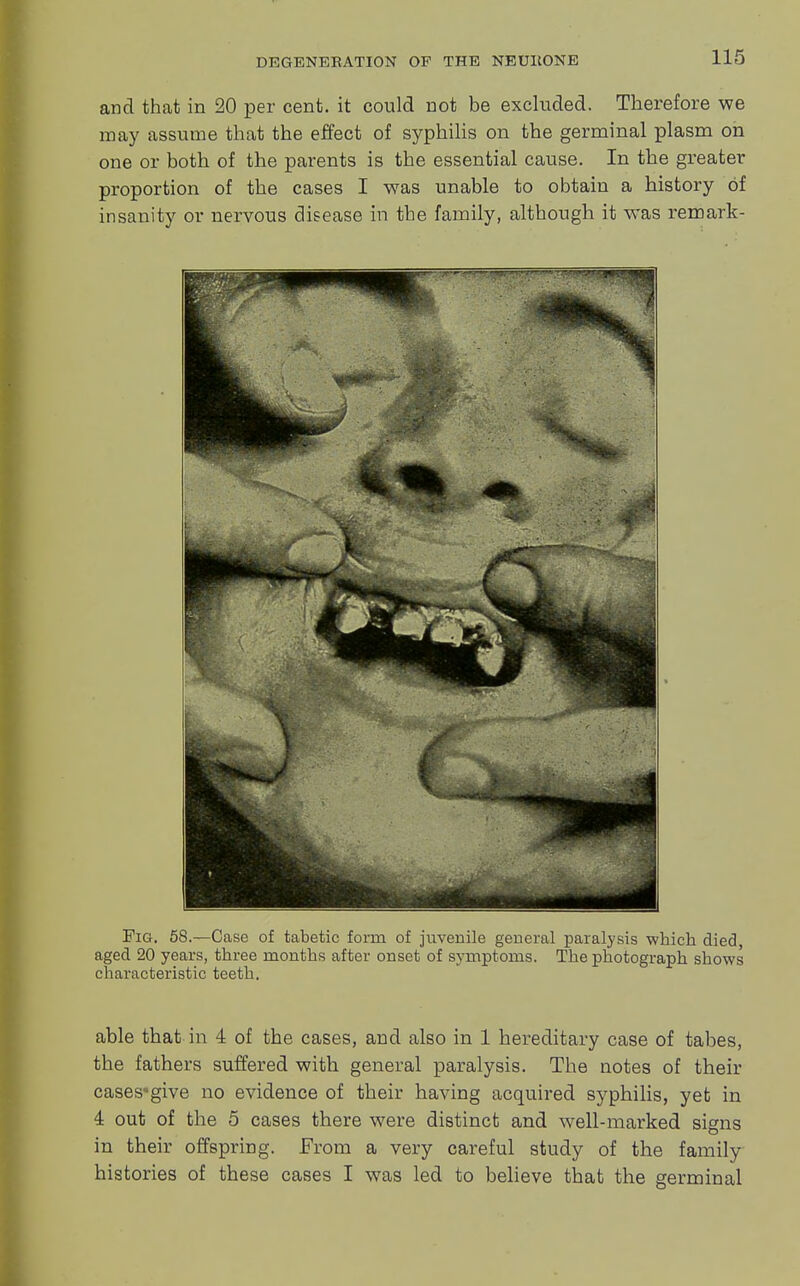 and that in 20 per cent, it could not be excluded. Therefore we may assume that the effect of syphilis on the germinal plasm oh one or both of the parents is the essential cause. In the greater proportion of the cases I was unable to obtain a history of insanity or nervous disease in the family, although it was remark- Fig. 58.—Case of tabetic form of juvenile general paralysis which died, aged 20 years, three months after onset of symptoms. The photograph shows characteristic teeth. able that in 4 of the cases, and also in 1 hereditary case of tabes, the fathers suffered with general paralysis. The notes of their cases-give no evidence of their having acquired syphilis, yet in & out of the 5 cases there were distinct and well-marked signs in their offspring. From a very careful study of the family histories of these cases I was led to believe that the germinal