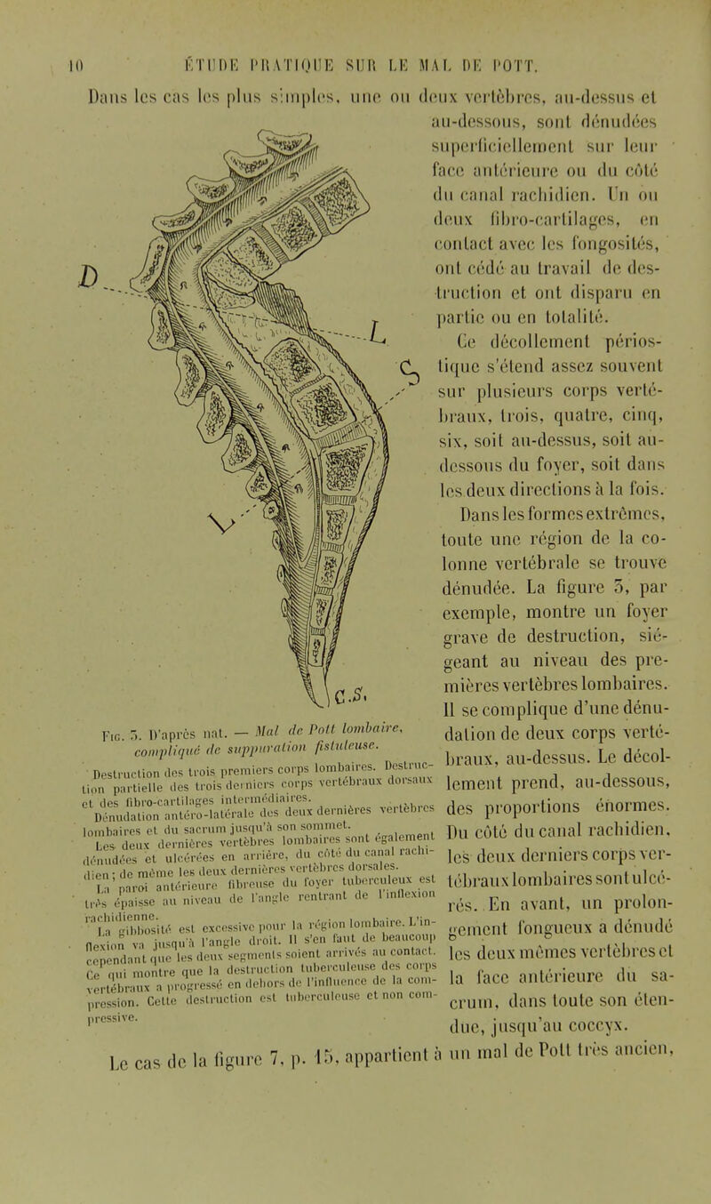 Dans les cas les plus simples, une ou deux vertèbres, au-dessus et au-dessous, sont dénudées superficiellement sur leur face antérieure ou du côté du canal rachidien. Un ou deux fibre-cartilages, en contact avec les fongosités, I) c^jM {^^^^' ont cédé au travail de des- truction et ont disparu en partie ou en totalité. Ce décollement périos- tique s'étend assez souvent sur plusieurs corps verté- braux, trois, quatre, cinq, six, soit au-dessus, soit au- dessous du foyer, soit dans les deux directions à la fois. Dans les formes extrêmes, toute une région de la co- lonne vertébrale se trouve dénudée. La figure 5, par exemple, montre un foyer grave de destruction, sié- geant au niveau des pre- mières vertèbres lombaires. 11 se complique d'une dénu- dalion de deux corps verté- braux, au-dessus. Le décol- F.c T.. D'après nat. - Mal de Poil lombaire complique de suppuration /islulruse. •Destruction .les trois premiers corps lombaires. Destruc lion partielle des trois derniers corps vertébraux dorsauv lement prend, ail-dcSSOUS, dernier ***** des proportions énormes. '^SxVeraKve^rmb^ont égalemen, DU côté ducanal rachidien denudéeS cl ulcérées en arriére, du coté du canal rachi- deux derniers COrps \ er ^t^^^^^^^S: tébrauxlombairessontulcé très e fpaisse au niveau de l'angle rentrant de l'inflexion res. En avant, un prolon- gement fongueux a dénudé '■'ii',:i,!:;;:;::;;i,é es. **** - .a n^^r.^- n n v. iusau'à L'angle droit. Il s'en faut de beaucoup Sendanl que les deux segments soienl arrivés au contact. [es deux mèlUCS vertebrCSCl tkS5^S«iS»!ï3: la lace antérieure du sa- pression. Celle destruction esl tuberculeuse etnoncora- dans toute SOIl éleil- prcss,ve' due, jusqu'au coccyx. Le cas de la ligure 7, p. 15, appartienl à an mal de Potl 1res ancien.