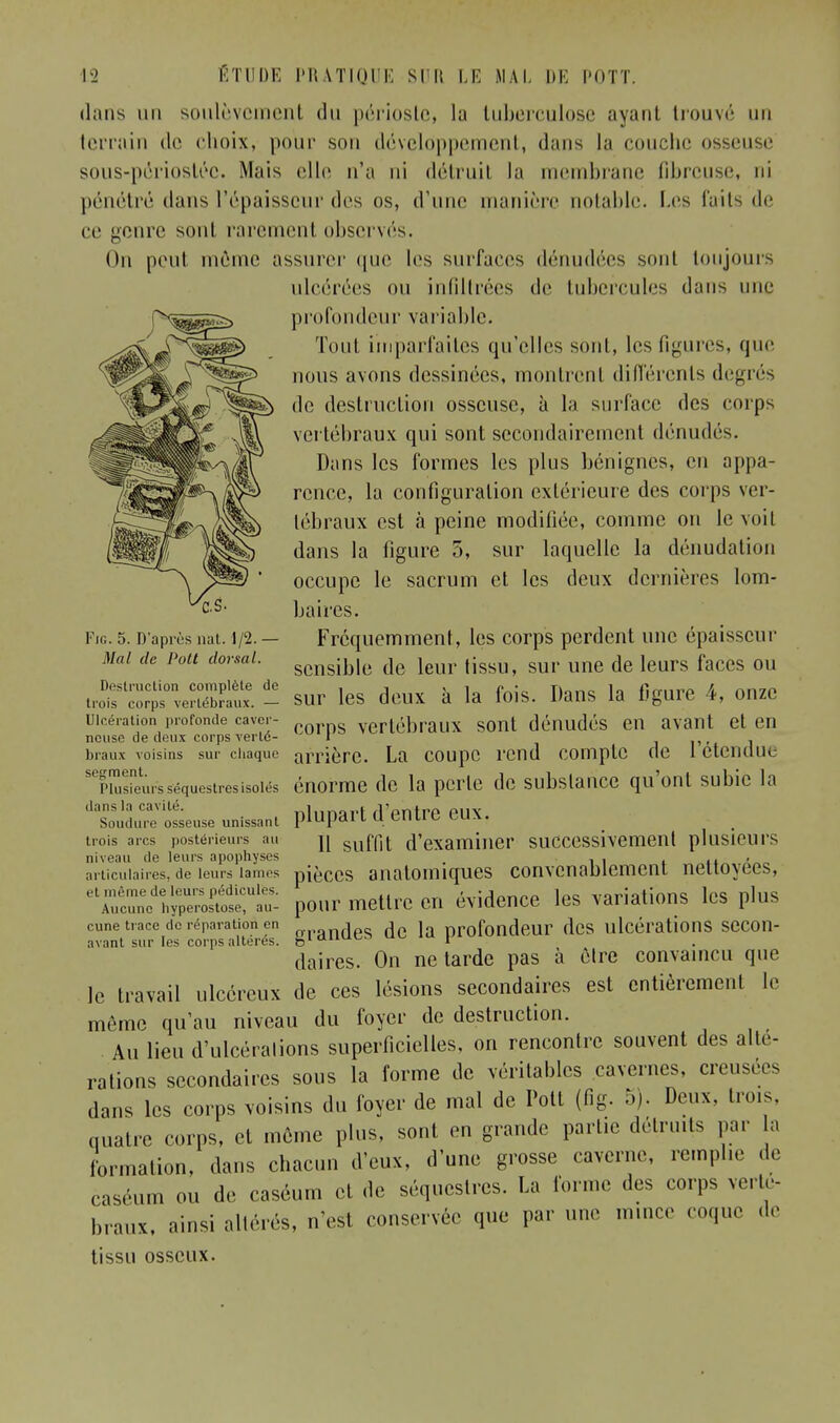 dans un soulèvement du périoste, la tuberculose ayant trouvé un terrain de choix, pour son développement, dans la couche osseuse sous-périostéc. Mais elle n'a ni détruil la membrane fibreuse, ni pénétré dans l'épaisseur des os, d'une manière notable. Les faits de ce genre sont rarement observés. On peut môme assurer que les surfaces dénudées sont toujours ulcérées ou infiltrées de tubercules dans une profondeur variable. Tout imparfaites qu'elles sont, les figures, que nous avons dessinées, montrent différents degrés de destruction osseuse, à la surface des corps vertébraux qui sont secondairement dénudés. Dans les formes les plus bénignes, en appa- rence, la configuration extérieure des corps ver- tébraux est «à peine modifiée, comme on le voit dans la figure 5, sur laquelle la dénudation occupe le sacrum et les deux dernières lom- baires. Fig. 5. D'après nat. 1/2. — Fréquemment, les corps perdent nue épaisseur Mal de Pou dormi. scnsible de leur tissu, sur une de leurs faces on troïïprveSauï. - sur les deux à la Ibis. Dans la figure 4, onze uif.é.aiion profonde cave.- rorns vertébraux sont dénudés en avant et en ncuse de deux corps verte- I , braux voisins sur chaque arrière. La coupe rend compte de 1 étendue 'rEùrs séquestres isolés énorme de la perle de substance qu'ont subie la unissanl plupart d'entre eux Soudure osseuse _ trois arcs postérieurs au j[ suffit d'examiner successivement plusieurs niveau de leurs apophyses . , . , articulaires, de leurs lames pièces anatoiniques convenablement nettoyées, r^^^ê?'^ pour mettre en évidence les variations les plus cune trace de réparation en „nflfis Ac Ja profondeur des ulcérations SCCOll- avant sur les corps altères. bla u 1 daires. On ne tarde pas à être convaincu que le travail ulcéreux de ces lésions secondaires est entièrement le même qu'au niveau du foyer de destruction. Au lieu d'ulcérations superficielles, on rencontre souvent des alté- rations secondaires sous la forme de véritables cavernes, creusées dans les corps voisins du foyer de mal de Polt (fig. 5). Deux, trois, quatre corps, et même plus, sont en grande partie détruits par a formation, dans chacun d'eux, d'une grosse caverne, remplie de caséum ou de caséum et de séquestres. La forme des corps verté- braux, ainsi altérés, n'est conservée que par une mince coque de tissu osseux.