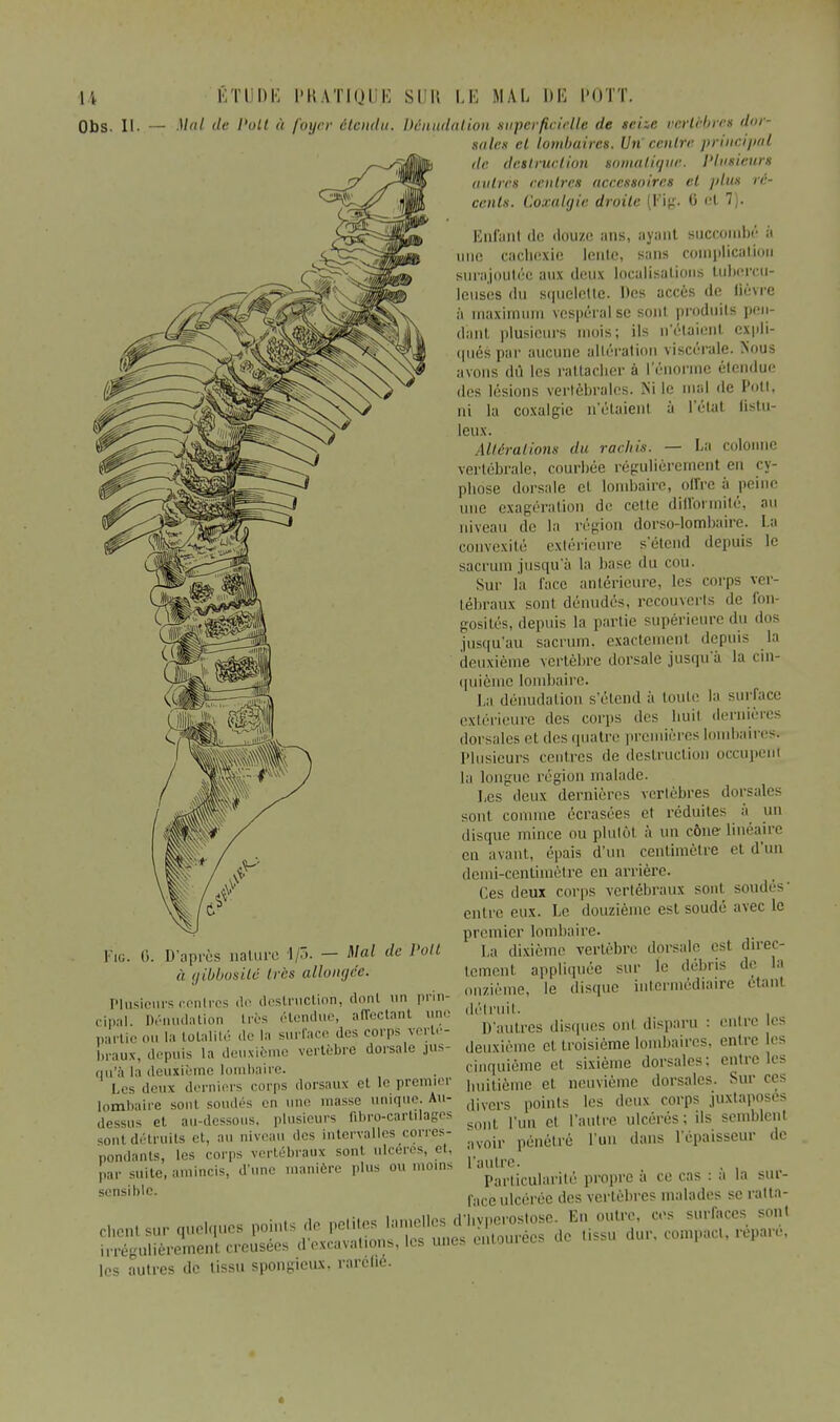 Obs. II. — Mal de Voit à foyer étendu, dénudation superficielle de sciic vertèbre» dor- sales et lombaires. Un centre principal de destruction soinaliyur. Plusieurs autres centres accessoires cl plus ré- cents. Coxalgie droite (Fig. G et 7). Enfant de douze ans, ayant succombé à une cachexie lente, sans complication surajoutée aux deux localisations tubercu- leuses du squclctle. Des accès de lièvre à maximum vespéral se sont produits pen- dant plusieurs mois; ils n'étaient expli- qués par aucune altération viscérale. Nous avons dû les rattacher à l'énorme étendue des lésions vertébrales. Xi le mal de Pott, ni la coxalgie n'étaient à l'état listu- leux. Altérai ions du racliis. — La colonne vertébrale, courbée régulièrement en cy- phose dorsale et lombaire, offre à peine une exagération de cette difformité, au niveau de la région dorso-lombaire. I:' convexité extérieure s'étend depuis le sacrum jusqu'à la base du cou. Sur la face antérieure, les corps ver- tébraux sont dénudés, recouverts de fon- gosités, depuis la partie supérieure du dos jusqu'au sacrum, exactement depuis la deuxième vertèbre dorsale jusqu'à la cin- quième lombaire. La dénudation s'étend à toute la surface extérieure des corps des huit dernières dorsales et des quatre premières I baires. Plusieurs centres de destruction occupent la longue région malade. Les deux dernières vertèbres dorsales sont comme écrasées et réduites à un disque mince ou plutôt à un cône linéaire en avant., épais d'un centimètre et d'un demi-centimètre en arrière. Ces deux corps vertébraux sont soudés' entre eux. Le douzième est soudé avec le premier lombaire. La dixième vertèbre dorsale est direc- tement appliquée sur le débris de la onzième, le disque intermédiaire étant détruit. D'autres disques oui disparu : entre les deuxième et troisième lombaires, entre les cinquième et. sixième dorsales: entre les huitième et. neuvième dorsales. Sur ces divers points les deux corps juxtaposes sont l'un et l'autre ulcérés ; ils semblent avoir pénétré l'un dans l'épaisseur de l'autre. Particularité propre à ce cas : a la sur- face ulcérée des vertèbres malades se ratta- surfaces sont Fig. (i. D'après nature 1/3. — Mal de Poil à gibbosilô très allongée. Plusieurs centres de destruction, dont un prin- cipal Dénudation très .'tendue, affectant une partie ou la totalité de la surface des corps verté- braux, depuis la deuxième vertèbre dorsale jus- qu'à la deuxième lombaire. Les ileux dernier- corps dorsaux et le premier lombaire sont soudes en une masse unique. Au- dessus et. au-dessous, plusieurs fibro-cartilages sont détruits et. au niveau .les intervalle- corres- pondants, les corps vertébraux sont ulcères, et, par suite, amincis, d'une manière plu- ou moins sensible. *.  • ^t^r^ZZ^^T^ un, irrégulièrement creusées d excavations, tes unes los autres de tissu spongieux, raréfié. ê