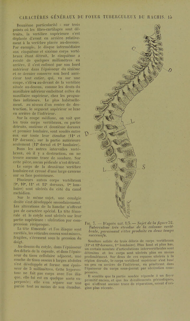 Deuxième particularité : sur trois points où les [ibro-cartilages son! dé- truits, la vertèbre supérieure s'est déplacée d'avant en arrière relative- ment à la vertèbre placée au-dessous. Par exemple, le disque intermédiaire aux cinquième ci sixième corps verté- braux étant détruit, le cinquième a reculé de quelques millimètres en arrière, il s'est enfoncé par son bord antérieur dans l'épaisseur du sixième el ce dernier conserve son bord anté- rieur tout entier, qui, vu sur une coupe, s'élève au-devant de la vertèbre s'il née au-dessus, comme les dents du maxillaire inférieur emboîtent celles du maxillaire supérieur, cbez les progna- thes inférieurs. Le plus habituelle- ment, au niveau d'un centre de des- truction, le segment supérieur se luxe en arrière de l'inférieur. Sur la coupe médiane, on voit (pic les trois corps vertébraux, en partie détruits, onziè I douzième dorsaux et premier lombaire, sont, soudés entre eux sur toute leur étendue (11e el. 12° dorsaux), sur la partie antérieure seulement ('12'dorsal et 1 lombaire:. Dans les autres intervalles verté- braux, où il y a destruction, on ne trouve aucune trace de soudure. Sur cette pièce, aucun pédicule u'esl détruit, Le corps de la deuxième vertèbre lombaire est. creusé d'une large caverne sur sa l'ace postérieure. Plusieurs autres corps vertébraux (9», 10, 11° et 12° dorsaux, I lom- baire) sont ulcérés du côté du canal ràchidien. Sur le même sujet, mie coxalgie droite s'est, développée secondairement. Les altérations de la hanche n'olfrenl pas de caractère spécial. La tète fémo- rale et. le cotyle sont ulcérés sur leur partie supérieure ; ulcération par com- pression réciproque* La trie fémorale el l'os iliaque sont raréfiés, les réticules osseux sont minces, fragiles, s'écrasent sons la pression du doigt. Au-dessus du COlyle, dans l'épaisseur desdébris de la capsule, el dans l'épais- seur du lissu cellulaire adjacent, une couche de tissu osseux à larges alvéoles s'est développée el forme une épais- seur de 5 millimètres. Cette hyperos- tose ne fait pas corps avec l'os ilia- 'l111'. elle bu esl en quelque sorte su- perposée; elle s'en sépare sur une partie tout au moins de son étendue. Fie. 7. — D'après nat.l/3-.~- Sujet de la figurefà. Tuberculose très étendue de la colonne verté- brale, paraissant s'être produite en deux temps successifs. Soudure solide de trois débris de corps vertébraux (11* et L2'dorsaux, l lombaire). Plus haut et plus bas, un certain nombre d'articulations intervertébrales sont détruites et les corps sont ulcérés plus ou moins profondément. Sur deux de ces espaces ulcérés à la région dorsale, le corps vertébral supérieur s'esi luxé nu peu en arrière de l'inférieur, en pénétrant dans l'épaisseur du corps sous-jaccnl par ulcération com- pressive. Il semble que la partie soudée réponde à un foyer primitif ancien, el que les décollements périostiques, qui n'offrent aucune trace de réparation, soient d'ori- gine plus récente.