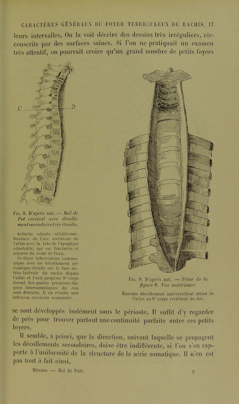 leurs intervalles, On la voit décrire des dessins très irréguliers, cir- conscrits par des surfaces saines. Si l'on ne pratiquait un examen très attentif, on pourrait croire qu'un grand nombre de petits foyers Fig. 8. D'après nat. — Mal de Pot cervical avec décolle- ment secondaire très étendu. Arthrite oilonlo - atloïdienne. Soudure de l'arc antérieur de l'atlas avec la tête de l'apophyse odoiitoïde, qui esl fracturée et séparée du reste de l'axis. Ce loyer tuberculeux commu- nique avec un décollement pé- riostique étendu sur la face, an- téro-iatérale du rachis depuis l'atlas et l'axis jusqu'au 9° corps dorsal. Les quatre premiers dis- ques inlersoniatiqucs du cou sont délr.uits. H en résulte une inflexion cervicale accentuée. Fig. 9. D'après nat. — Pièce de la figure 8. Vue nul cri cure. Énorme décollement antéver'tébral allant de L'atlas ;iu 9 corps vertébral du dos. se sont développés isolément sons le périoste. H suffit d'y regarder de près pour trouver partout une continuité parfaite entre ces petits loyers. II. semble, a priori, que la direction, suivant laquelle se propagent les décollements secondaires, doive rire indifférente, si Ton s'en l'ap- porte à l'uniformité dq la structure de la série somatique. Il n'en est pas tout à fait ainsi. SfÉNARD. — Mal de l'Oit. 9