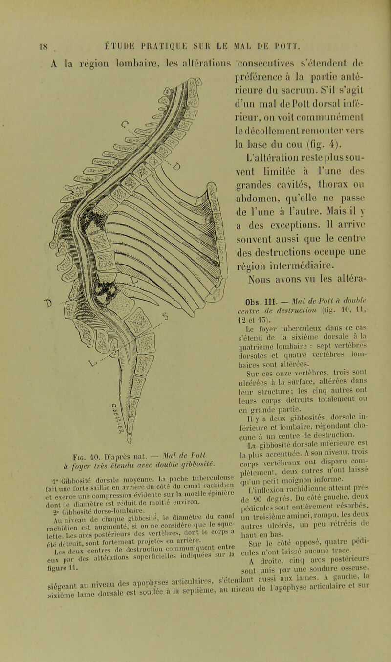A la région lombaire, les altérations consécutives s'étendent de préférence à la partie anté- rieure du sacrum. S'il s'agit d'un mal de Pott dorsal infé- rieur, on voit communémcnl le décollement remonter vers la base du cou (tig. 4). L'altération reste plus sou- vent limitée à l'une des grandes cavités, thorax ou abdomen, qu'elle ne passe de l'une à l'autre. Mais il y a des exceptions. Il arrive souvent aussi que le centre des destructions occupe une région intermédiaire. Nous avons vu les altéra- Obs. III. — Mal de Pott à double centre de destruction (fig. 10, 11, •12 et 15). Le foyer tuberculeux clans ce cas s'étend île la sixième dorsale à la quatrième lombaire : sept vertèbres dorsales et quatre vertèbres lom- baires sont altérées. Sur ces onze vertèbres, trois sont ulcérées à la surface, altérées dan- leur structure; les cinq autres ont leurs corps détruits totalement ou en grande partie. Il v a deux glbbosités, dorsale in- férieure et lombaire, répondant cha- cune à un centre de destruction. La gibbosité dorsale inférieure est la plus accentuée. A son inveau, trois corps vertébraux ont disparu roui- Fie. 10. D'après nat. — Mal de Poil à foyer très étendu avec double gibbosité. i J plètément, deux autres n ont laissi V Gibbosité dorsale moyenne. La poche tuberculeuse . | j( moign0n informe, fait une forte saillie en arriére du côté du cana rachidien r.in[lcxïon racbidienne atteint près el exerce une compression évidente sur la moelle épinière don) |e diamètre est réduit de moitié environ. -<• Gibbosité dorso-lômbaire. \„ niveau de chaque gibbosité, le diamètre du rimai rachidien est augmenté, si on ne considère que le sque- lette Les arcs postérieurs des vertèbres, dont le corps a ,Hé détruit, sont fortement projetés en arrière. PS deux centres de destruction communiquent entre ,,„, par des ..Itérations superficielles indiquées sur la ligure 11. li I Mlll \lu i ' ' i ,1,. 90 degrés. Du côté gauche, doux pédicules sont entièrement résorbés, un troisième aminci, rompu, les deux autres ulcérés, un peu rétrécis de haut eu bas. Sur le côté opposé, quatre pédi- cules n'ont laissé aucune trace. droite, cinq arcs postérieurs A . sont unis par une soudure osseuse