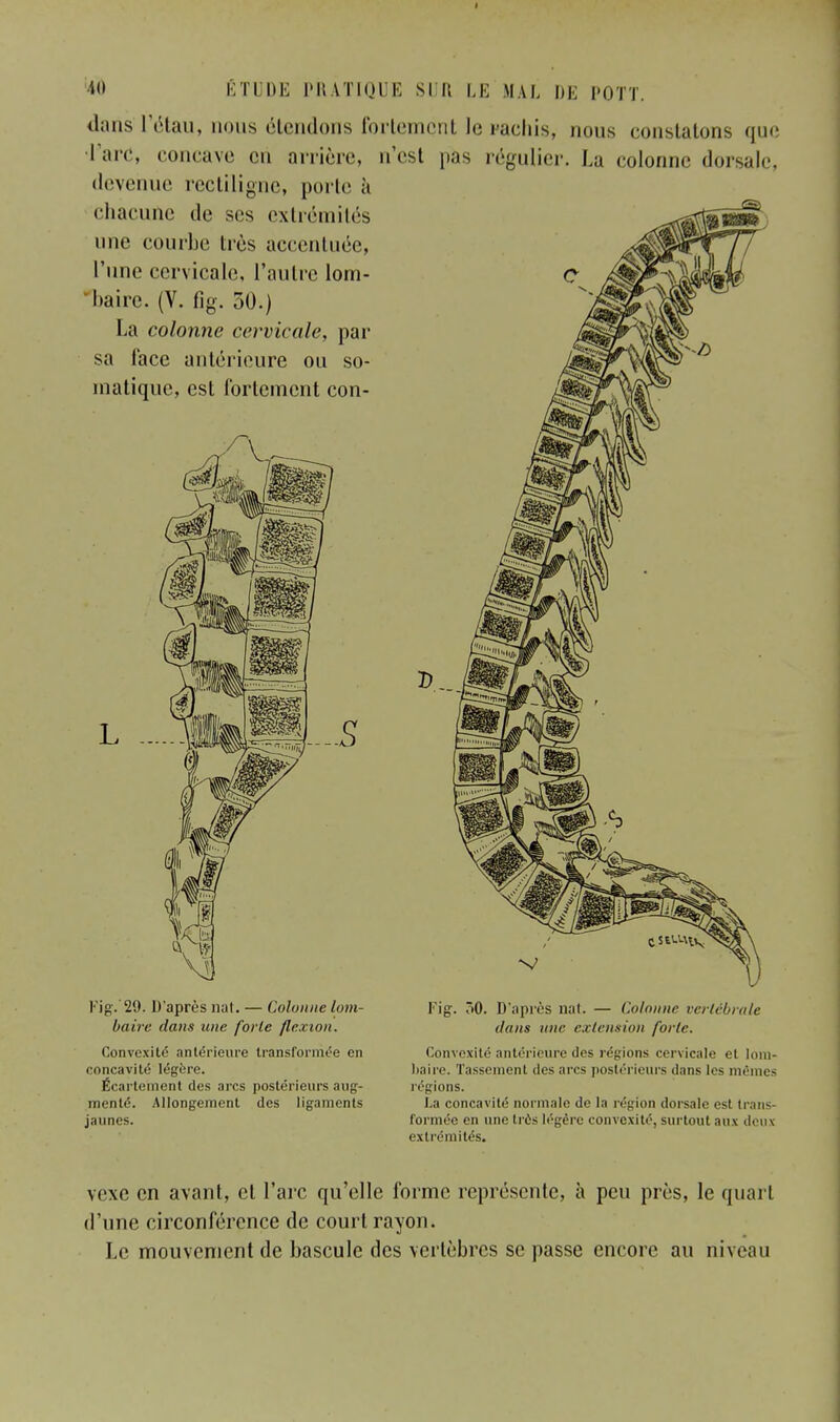 dans l'étail, nous étendons fortement le Pachis, nous constatons que Tare, concave en arrière, n'est pas régulier. La colonne dorsale, devenue rectiligne, porte à chacune de ses extrémités une courbe très accentuée, l'une cervicale, l'autre lom- baire. (V. fig. 50.) La colonne cervicale, par sa lace antérieure ou so- matique, est Ibrlemcnt con- L Fig. 29. D'après nat. — Colonne lom- baire dans une forte flexion. Convexité antérieure transformée en concavité légère. Écartement des arcs postérieurs aug- menté. Allongement des ligaments jaunes. Fig. >0. D'après nat. — Colonne vertébrale dans mw extension forte. Convexité antérieure des régions cervicale et lom- baire. Tassement des arcs postérieurs dans les mêmes régions. La concavité normale de la région dorsal*1 esl trans- formée en une très légère convexité, surtout aux deux extrémités. vexe en avant, cl l'arc qu'elle forme représente, à peu près, le quart d'une circonférence de court rayon. Le mouvement de bascule des vertèbres se passe encore au niveau