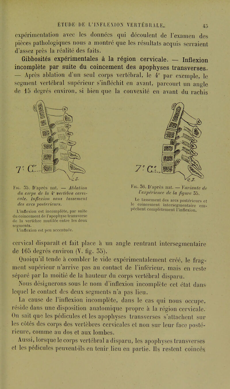 expérimentation avec les données qui découlent de l'examen des pièces pathologiques nous a montré que les résultats acquis serraient d'assez près la réalité des faits. Gibbosités expérimentales à la région cervicale. — Inflexion incomplète par suite du coincement des apophyses transverses. — Après ablation d'un seul corps vertébral, le 4e par exemple, le segment vertébral supérieur s'infléchit en avant, jparcourt un angle de 15 degrés environ, si bien que la convexité en avant du rachis T- Ci 7' Cl Fig. 36. D'après nat. — Variante de l'expérience de la figure 35. Le tassement des arcs postérieurs et le coincement intersegmentalre em- pêchent complètement l'inflexion. Fig. 55. D'après nat. — Ablation du corps de la 4 vertèbre cervi- cale, inflexion sans tassement des arcs postérieurs. L'inflexion est incomplète, par suite du coincement de l'apophyse transverse de la vertèbre mutilée entre les deux segments. L'inflexion est peu accentuée. cervical disparaît et fait place à un angle rentrant interseginentairc de 165 degrés environ (Y. fig. 55). Quoiqu'il tende à combler le vide expérimentalement créé, le frag- ment supérieur n'arrive pas au contact de l'inférieur, mais en reste séparé par la moitié de la hauteur du corps vertébral disparu. Nous désignerons sous le nom d'inflexion incomplète cet étal dans lequel le contact des deux segments n'a pas lieu. La cause de l'inflexion incomplète, dans le cas qui nous occupe, réside dans une disposition auatomique propre à la région cervicale. On sait que les pédicules et les apophyses transverscs s'attachent sur Les côtés des corps des vertèbres cervicales et non sur leur face posté- rieure, comme au dos et aux lombes. Aussi, lorsque le corps vertébral a disparu, les apophyses transverses et les pédicules peuvent-ils en tenir lieu en partie. Ils restent coincés.