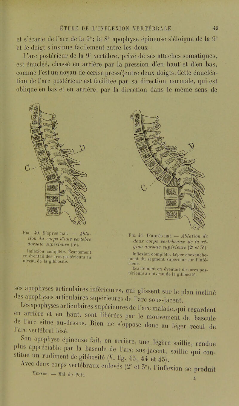 et s'écarte de l'àrc do la 9e; la 8e apophyse épineuse s'éloigne de la 9° et le doigt s'insinue facilement entre les deux. L'arc postérieur de la 9° vertèbre, privé de ses attacher somatiques, est énucléé, chassé en arrière par la pression d'en haut et d'en Las, comme l'est un noyau de cerise pressé^entre deux doigts. Cette énucléa- tion de l'arc postérieur est facilitée par sa direction normale, qui est oblique en bas et en arrière, par la direction dans le même sens de Fig. M). D'après mit. — Abla- tion du coi'ps il'une vertèbre dorsale supérieure (3°). Inflexion complète. Écartement en éventail des arcs postérieurs au iii\<';iu de la gibbosité. Fig. 41. D'après nat.— Ablation de finir corps vertébraux de lu ré- gion dorsale supérieure (2 et 5). Inflexion complète. Léger chevauche- ment du segment supérieur sur l'infé- rieur. Écartement en éventail des arcs pos- térieurs au niveau de la gibbosité. ses apophyses articulaires inférieures, qui glissent sur le plan incliné des apophyses articulaires supérieures de l'arc sous-jacenl Les apophyses articulaires su périeures de l'arc malade, qui regardent en arrière et en haut, sont libérées par le mouvement de bascule de lare situé au-dessus. Rien no s'oppose donc au léger recul de I arc vertébral lésé. Soi, apophyse épineuse fait, en arrière, une légère saillie rendue P -;PP^able par la bascule de l'arc sus-jacent, saillie qu ^n- stitue un rudiment de gibbosité (V. fig. 45, 44 et 45) Avec deux corps vertébraux enlevés (2e et 3e), l'inflexion se produit MéNAIID. — Mal de Pott.
