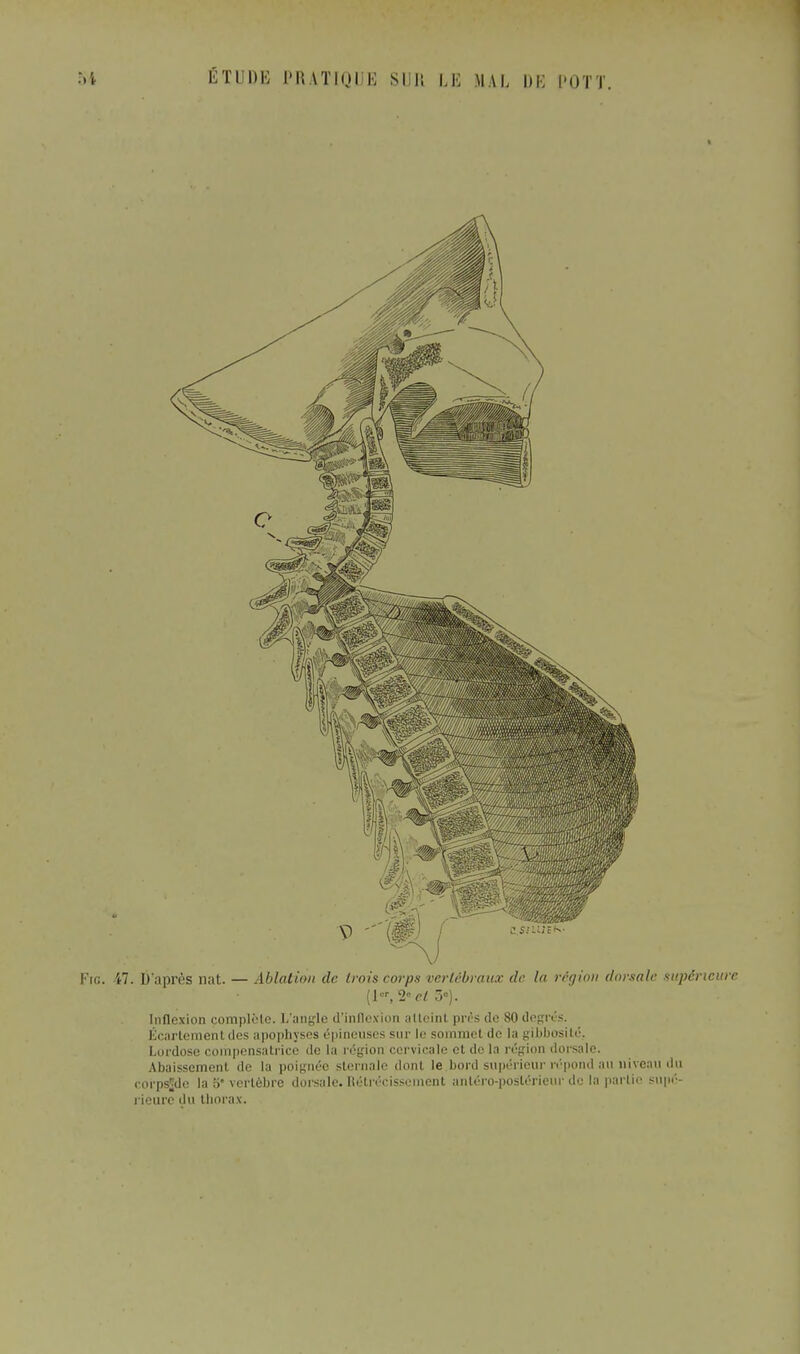 Fig. 47. D'après nat. — Ablation de trois corps vertébraux de la région dorsale supérieure (lor, 2° et 5°). Inflexion complote. L'angle d'inflexion atteinl prés de 80 degrés. Écartemenl des apophyses épineuses sur le sommel de la gibbosité. Lordose compensatrice de la l égion cervicale et de la région dorsale. Abaissement de la poignée sternale dont le bord supérieur répond an niveau du corpsjde la 5* vertèbre dorsale. Rétrécissement antéro-pos'lérieur do la partie supé- rieure du thorax.