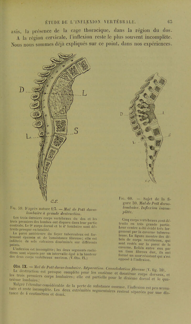 avis, la présence de la cage thoracique, dans la région du dos. A la région cervicale, l'inflexion reste le plus souvent incomplète. Nous nous sommes déjà expliqués sur ce point, dans nos expériences. as. I''ti. 59. D'après .nature 1/3. — Mal de Poli dorso- lombaire à grande destruction. Les trois derniers corps vertébraux du dos ci les trois premiers des lombes ont disparu dans leur partie centrale. Le 9' corps dorsal cl le i' lombaire sont dé- i nui- presque en totalité. La paroi antérieure du foyer tuberculeux est for- tement épaissie cl de consistance fibreuse; le esl infiltrée de sels calcaires dissémines sur différents points. L'inflexion est incomplète ; les deux segments rachi- « icns sont séparés par un intervalle égal à la hauteur des deux corps vertébraux environ. (V. Obs. IX.) D -, Fie. GO. - Sujet de In fi- gure 511. Mal de Poil dorso- lombaire. Inflexion iticom- ]>lcle. Cinq corps vertébraux font dé- truits eu très grande partie. Leur centre a été évidé très lar- gement par la caverne tubercu- leuse. La ligure montre des dé- bris de corps vertébraux, qui soûl restés sur la paroi de la caverne. Reliés entre eux par » tissu fibreux dur, ils oui formé un mur résistant qui s'esi opposé à l'inflexion. Obs. IX. - Mal de Pottdorso-lombaire. Réparation. Consolidation fibreuse V fis 7) U destruefon esl presque complète pour les onzième el douzième covl doSauv ni [riirœrcorps 1 aires;el s pour ie dMé Eau0;^ . M;'L,' l'fte.nd^considéri de l,- rte de substance osseuse l'inflexion esl ne,, ne • > '^TlV^S^tlJ.8868 — STJI