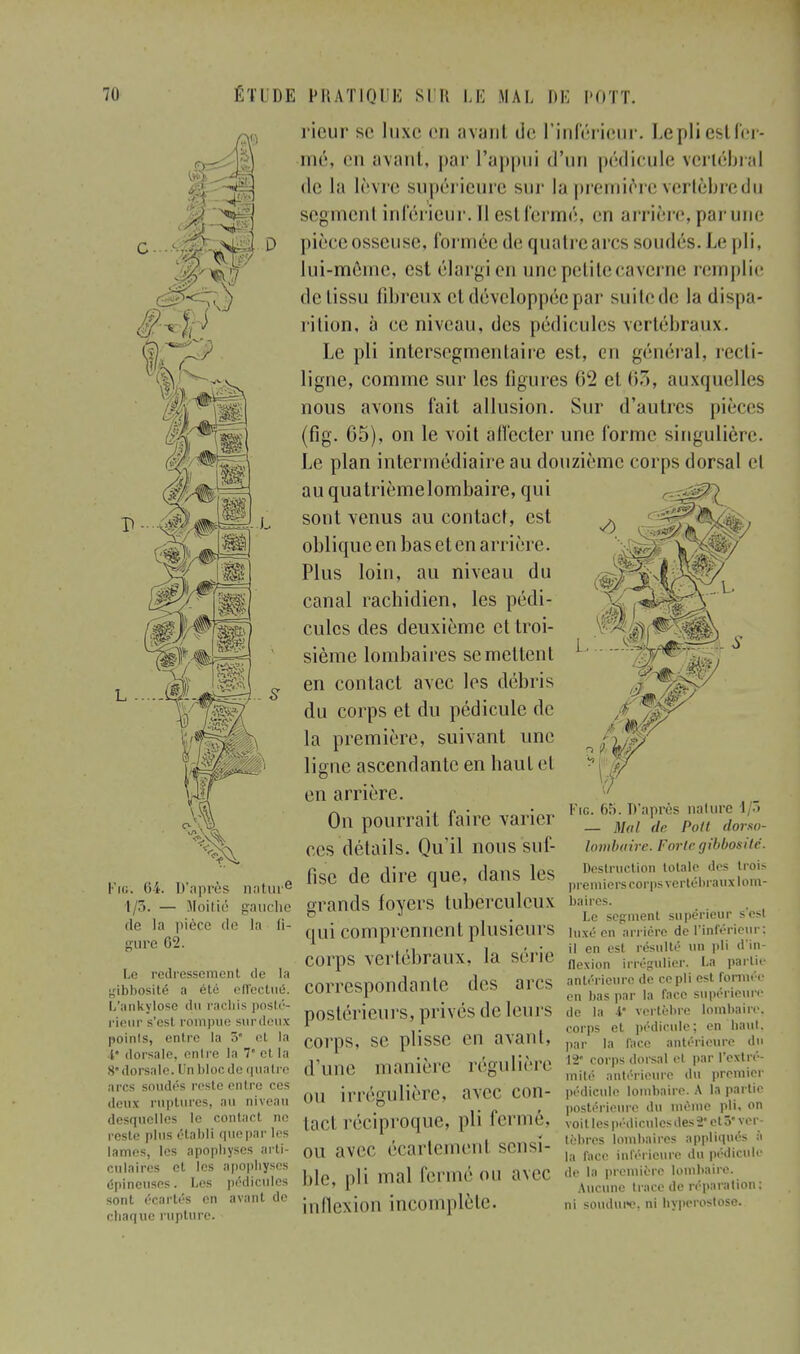 if* Pig. D'après nature t/3. — Moitié gauche île la pièce île la li- gure 62. Le redressement de la gibbosité a été effectué. L'ankylose du rachis posté- rieur s'esl rompue surdeux poinls, entre la 5 cl la i dorsale, entre la 7 et la 8*dorsale. Un blocde quatre arcs soudés reste entre ces deux ruptures, au niveau desquelles le contael ne reste plus établi quepar les lames, les apophyses arti- culaires et les apophyses épineuses. Les pédicules sont écartés en avant de chaque rupture. rieur se luxe en ayant de l'inférieur. Le pli est fer- mé, en avant, par l'appui d'un pédicule vertébral de la lèvre supérieure sur la première vertèbredu segment inférieur. Il esl fermé, ru arrière, par une pièce osseuse, formée de quatre arcs soudés. Le pli, lui-même, est élargi en une petite caverne remplie delissu fibreux et développée par suitede la dispa- rition, à ce niveau, des pédicules vertébraux. Le pli inlcrsegmentaire est, en général, recti- ligne, comme sur les figures 62 el (i.), auxquelles nous avons fait allusion. Sur d'autres pièces (fig. 05), on le voit affecter une forme singulière. Le plan intermédiaire au douzième corps dorsal el au quatrième lombaire, qui sont venus au contact, est oblique en bas et en arrière. Plus loin, au niveau du canal rachidien, les pédi- cules des deuxième et troi- sième lombaires se mettent en contact avec les débris du corps et du pédicule de la première, suivant une ligne ascendante en haut et en arrière. On pourrait faire varier ces détails. Qu'il nous suf- fise de dire que, dans les arands fovers tuberculeux baires. 0 J . Le segment supérieur s esl (llli Comprennent plusieurs luxéen arriére de l'inférieur; . .1 i„ „ - • il en esl résulté un pli d in- corps vertébraux, la sene flevjon irrégulier. La partie correspondante des arcs ïïî£ÏSff£SS£ postérieurs, privés (le leurs de la 4* vertèbre lombaire, 1 ,. . corps et pédicule; en haut, corps, se plisse Cil avant, par Ia r;lcc antérieure du d'une manière régulière mi irrégulière, avec con- tact réciproque, pli fermé, on avec écartement sensi- ble, pli mal fermé ou avec inflexion incomplète. Fig. 65. D'après nature 1/5 — Mal de Polt dorso- lombairc. Forte gibbosilé. Destruction totale des trois premiers corps vertébraux lom- 12* corps dorsal et par l'extré- mité antérieure du premier pédicule lombaire. A la partie postérieure du même pli, on voit les pédicules des 2 et 5* ver- tèbres lombaires appliqués à la face inférieure du pédicule de la première lombaire. Aucune trace de réparation: ni sOU'dure, ni byperostose.