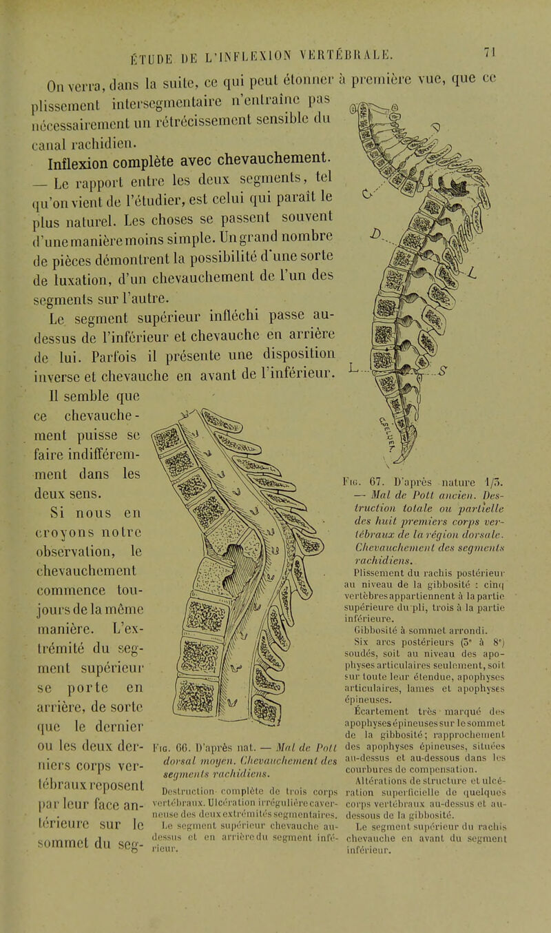 On verra, dans la suite, ce qui peut étonner à première vue, que ce plissement mtersegmentaire n'entraîne pas nécessairement un rétrécissement sensible du canal raehidien. Inflexion complète avec chevauchement. — Le rapport entre les deux segments, tel qu'on vient de l'étudier, est celui qui paraît le plus naturel. Les choses se passent souvent d'une manière moins simple. Un grand nombre de pièces démontrent la possibilité d une sorte de luxation, d'un chevauchement de l'un des segments sur l'autre. Le segment supérieur infléchi passe au- dessus de l'inférieur et chevauche en arrière de lui. Parfois il présente une disposition inverse et chevauche en avant de l'inférieur. Il semble que ce chevauche - ment puisse se faire indifférem- ment dans les deux sens. Si nous en croyons notre observation, le chevauchement commence tou- jours delà même manière. L'ex- trémité du seg- ment supérieur se porte en arrière, de sorte que le dernier ou les deux der- niers corps ver- tébraux reposent par leur face an- térieure sur le sommet du seg- I'ig. 66. D'après nat. — Mal de Pott dorsal moyen. Chevauchement (1rs segmenlu rachidiens. Destruction complète de huis corps vertébraux. Ulcération irrégulière caver- neuse des deux extrémités segmentaires. Le segmenl supérieur chevauche au- dessus et en arrièrcdu segment infé- rieur. Fin. 67. D'après nature 1/3. — Mal de Poil ancien. Des- truction totale ou 'partielle des huit premiers corps ver- tébraux de la région dorsale. Chevauchement des segments rachidiens. Plissement du rachis postérieur au niveau de la gibbosité : cin<| vertèbres appartiennent à la partie supérieure du pli, trois à la partie inférieure. Gihbosité à sommet arrondi. Six- arcs postérieurs (5 à Nri soudés, soit au niveau des apo- physes articulaires seulement, soiI sur toute leur étendue, apophyses articulaires, lames et apophyses épineuses. Ecartemcnt très marqué des apophyses épineuses sur le sommet de la gibbosité; rapprochement des apophyses épineuses, Situées au-dessus et au-dessous dans les courbures de compensation. Altérations déstructure et ulcé- ration superficielle de quelques corps vertébraux au-dessus el au dessous de l'a gibbosité. segmenl supérieur du rachis chevauche en avanl du segmenl inférieur.