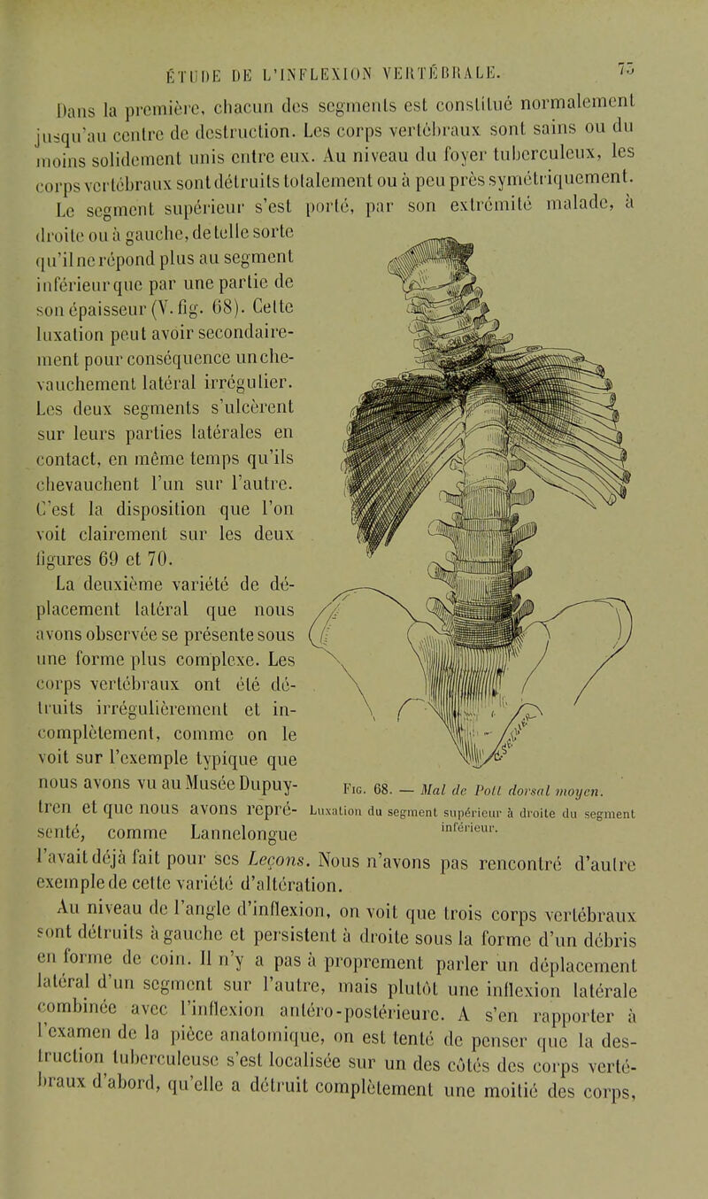 corps vertébraux sontclélruits totalement ou à peu près symétriquement. Le segment supérieur s'est porté, par son extrémité malade, à droite ou à gauche, de telle sorte qu'ilnerépond plus au segment inférieur que par une partie de son épaisseur (V.fig. 68). Celte luxation peut avoir secondaire- ment pour conséquence un che- vauchement latéral irrégulier. Les deux segments s'ulcèrent sur leurs parties latérales en contact, en même temps qu'ils chevauchent l'un sur l'autre. C'est la disposition que l'on voit clairement sur les deux ligures 69 et 70. La deuxième variété de dé- placement latéral que nous avons observée se présente sous une forme plus complexe. Les corps vertébraux ont été dé- truits irrégulièrement et in- complètement, comme on le voit sur l'exemple typique que nous avons vu au Musée Dupuy- tren et que nous avons repré- senté, comme Lannelongue l'avait déjà fait pour ses Leçons. Nous n'avons pas rencontré d'autre exemple de celte variété d'altération. Au niveau de l'angle d'inflexion, on voit que trois corps vertébraux sont détruits à gauche et persistent à droite sous la forme d'un débris eu forme de coin. Il n'y a pas à proprement parler un déplacement latéral d'un segment sur l'autre, mais plutôt une inflexion latérale combinée avec l'inflexion anléro-postérieure. A s'en rapporter à l'examen de la pièce anatomique, on est tenté de penser que la des- truction tuberculeuse s'est localisée sur un des côtés des corps verté- braux d'abord, qu'elle a détruit complètement une moitié des corps, Fig. 68. — Mal de Poil dorsal moyen. Luxation du segment supérieur à droite du segment inférieur.