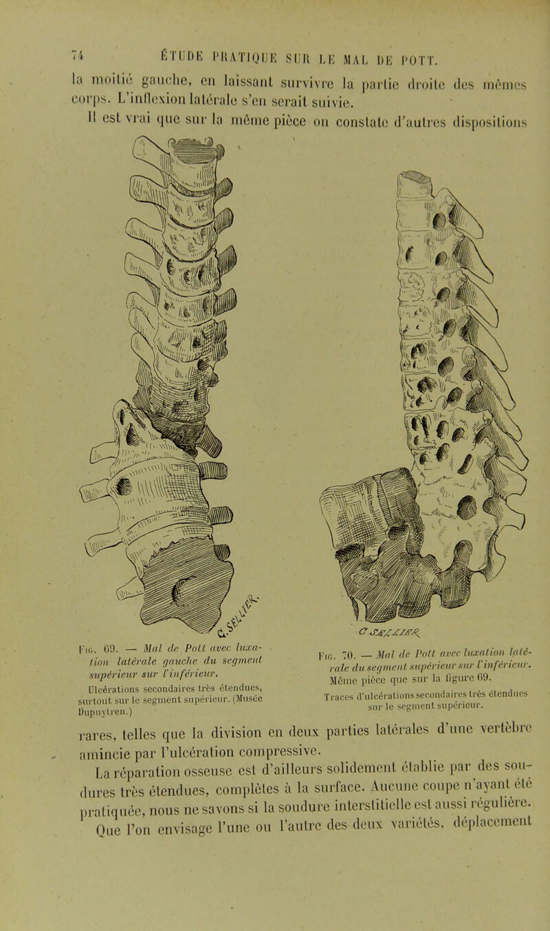 la moitié gauche, en laissant survivre la partie droite des mêmes corps. L'inflexion latérale s'en serait suivie. Il est vrai que sur la même pièce on constate d'autres dispositions I n,. 69. — Mal de Poil avec luxa- tion latérale gauche du segment supérieur sur l'inférieur. Ulcérations secondaires Iri s ('tendues, surtout sur le segment supérieur. (Musée Dupuytren.) Fjo. 0. _ Mal de Poil arec luxation laté- rale du segment supérieur sur l'inférieur. Même pièce que sur la figure 09. Traces d'ulcérations secondaires très étendues sur le segment supérieur. rares, telles que la division en deux parties latérales d'une vertèbre amincie par l'ulcération compressive. La réparation osseuse est d'ailleurs solidemei.1 établie par .les sou- dures très étendues, complètes à la surface. Aucune coupe n'ayant été pratiquée, nous ne savons si la soudure interstitielle est aussi régulière. Que l'on envisage l'une ou l'autre des deu* variétés, déplacement