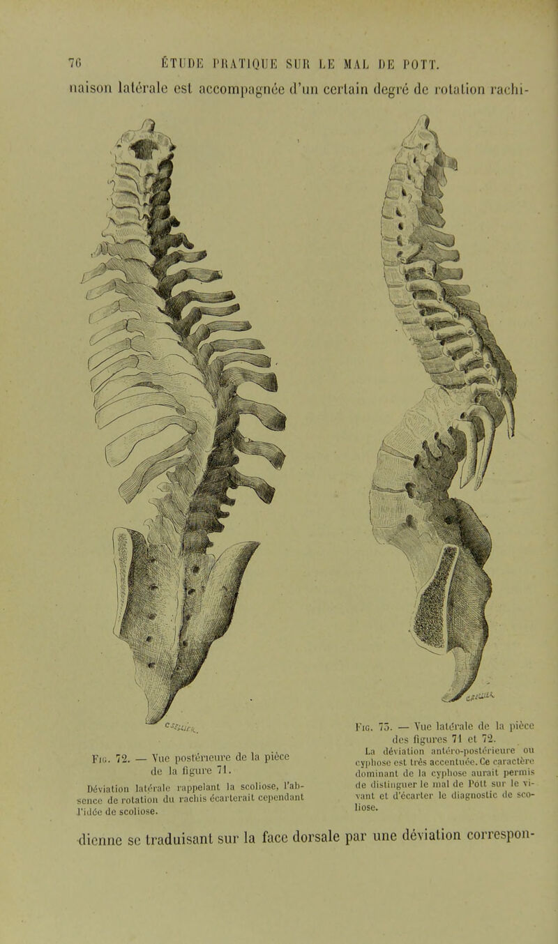 naison latérale csl accompagnée d'un certain degré de rotation rachi- Déviation latérale rappelant la scoliose, l'ab- de distinguer le mal de l'oit sur le vi- scnce de rotation du rachis écarterait cependant vaht et d'écarter le diagnostic de sco- l'idôe de scoliose. hose- dienne se traduisant sur la face dorsale par une déviation correspon-