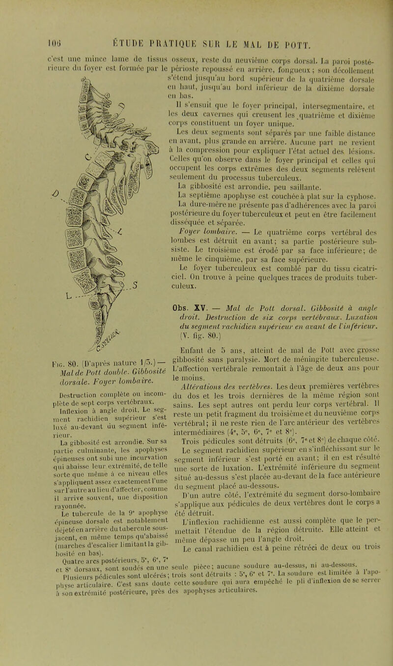 c'est une mince lame de tissus osseux, reste du neuvième corps dorsal. La paroi posté- rieure du foyer est formée pur le périoste repoussé on arriére, fongueux ; son décollement s'étend jusqu'au bord supérieur de la quatrième dorsale en haut, jusqu'au bord inférieur de lu dixième dorsale en lias. 11 s'ensuil cpie le foyer principal, intersegmenlaire, et les deux cavernes qui creusent Jcs quatrième et dixième corps constituenl un foyer unique. Les deux segments sont séparés pur une faible distance en avant, plus grande on arrière. Aucune pari ne revient à la compression pour expliquer l'état actuel des lésions. Celles qu'on observe duns le foyer principal et celles qui occupent les corps extrêmes des deux segments relèvent seulemenl du processus tuberculeux. La gibbosilé esl arrondie, peu saillante. La septième apophyse est couchée à plat sur la cyphose. La dure-mère ne présente pas d'adhérences avec la paroi postérieure du foyer tuberculeux et peut en être facilement disséquée et séparée. Foyer lombaire. — Le quatrième corps vertébral des lombes est détruit en avant; sa partie postérieure sub- siste. Le troisième est érodé par sa face inférieure; de même le cinquième, par sa face supérieure. Le foyer tuberculeux est comblé par du tissu cicatri- ciel. On trouve à peine quelques traces de produits tuber- culeux. Obs. XV. — Mal de Poil dorsal. Gibbosilé à angle droit. Destruction de six corps vertébraux. Luxation du segment rachidien supérieur en avant de l'inférieur. (V. fig. 80.) Lofant de 5 ans, atteint de mal de l'oit avec grosse Fie 80 (D'après nature 1/5 )— Siljl,osité sans paralysie. Mort de méningite tuberculeuse. Malde Pott double. Gibbosilé L'affection vertébrale remontait à l'âge de deux ans pour dorsale. Foyer lombaire. le moins. J Altérations des vertèbres. Les deux premières vertèbres Destruction complète ou incom- ju ^os et ]eg trojs devnières de la même région sont plète de sept corps vertébraux. sa{ns. Les sept autres ont perdu leur corps vertébral. 11 Inllexion à angle droit. Le seg- un fragment du troisième et du neuvième corps SÎ.SSÏÏfVïïîrïï infé- vertébral; il ne reste rien de l'arc antérieur des vertèbres intermédiaires (4°, 5°, 0e, 7e et 8). Trois pédicules sont détruits (6°, 7 et 8°) de chaque côté. Le segment rachidien supérieur ens'infléchissant sur le segment inférieur s'est porté en avant; il en est résulté une sorte de luxation. L'extrémité inférieure du segmenl situé au-dessus s'est placée au-devant delà face antérieure rieur. La gibbosité est arrondie. Sur sa partie culminante, les apophyses épineuses ont subi une incurvation qui abaisse leur extrémité, de telle sorte que même à ce niveau elles s'appliquent assez exactement l'une s annuuueni assez exaciujuemi une , -, .urrautre au lieu d'affecter, comme dusegment place au-dessous il arrive souvent, une disposition i a vi innée. Le tubercule de la 9 apophyse épineuse dorsale est notablement déjeté en arrière du tubercule sous- jacent, en même temps qu'abaissé (marches d'escalier limitantla gib- bosilé en lias). Quatre arcs postérieurs, 5*, 6*, 7* . ci 8 dorsaux sont soudés en une seule pièce; aucune soudure au-dessus, m au-dessous. Plusieurs pédicules sont ulcérés; trois sont détruits : 5-, 6' et V. La soudure estlimitée , lapa ph^aSaiw Ces! sans do setfee soudure qui aura empêché le pli d'.uflexion de se s a sonextrémité postérieure, près des apophyses articulaires. D'un autre côté, l'extrémité du segmenl dorso-lombaire s'applique aux pédicules de deux vertèbres dont le corpsa été détruit. L'inflexion rachidienne esl aussi complète que le per- mettait l'étendue de la région détruite. Elle atteint et même dépasse un peu l'angle droit. Le canal rachidien est à peine rétréci de deux ou trois