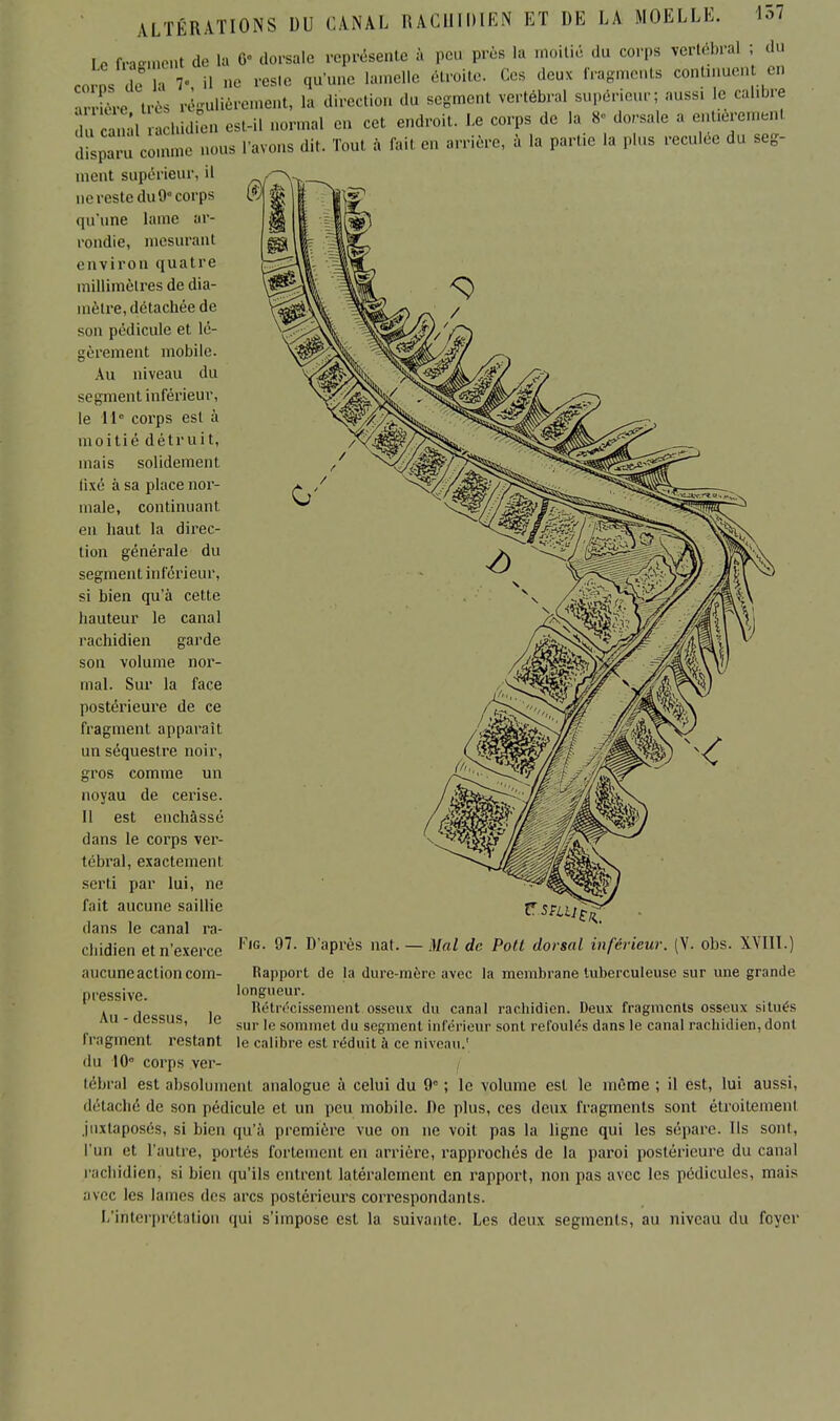 Le fragment de la 6- dorsale représente à peu près la moitié du corps vertébral ; du Jl de h 7- il ne reste qu'une lamelle étroite. Ces deux fragments contiriuen en Sre très régulièrement, la direction du segment vertébral supérieur; auss, le calibre rcanal rachidien est-il normal en cet endroit. Le corps de la 8- dorsale a cnUeremenl disparu comme nous l'avons dit. Tout à fait en arrière, à la partie la plus reculée du seg- ment supérieur, il ne reste du 9° corps qu'une laine ar- rondie, mesurant • aviron quatre millimètres de dia- mètre, détachée de son pédicule et lé- gèrement mobile. An niveau du segment inférieur, le 11e corps est à moitié détruit, mais solidement tixé à sa place nor- male, continuant en haut la direc- tion générale du segment inférieur, si bien qu'à cette hauteur le canal rachidien garde son volume nor- mal. Sur la face postérieure de ce fragment apparaît un séquestre noir, gros comme un noyau de cerise. 11 est enchâssé dans le corps ver- tébral, exactement, serti par lui, ne fait aucune saillie dans le canal ra- chidien et n'exerce aucune action com- pressive. Au - dessus, le fragment restant du 10 corps ver- tébral est absolument analogue à celui du 9e ; le volume est le même ; il est, lui aussi, détaché de son pédicule et un peu mobile. De plus, ces deux fragments sont étroitement juxtaposés, si bien qu'à première vue on ne voit pas la ligne qui les sépare. Ils sont, l'un et l'autre, portés fortement, en arrière, rapprochés de la paroi postérieure du canal rachidien. si bien qu'ils entrent latéralement en rapport, non pas avec les pédicules, mais avec les lames des arcs postérieurs correspondants. L'interprétation qui s'impose est la suivante. Les deux segments, au niveau du foyer Fie 97. D'après nat. — Mal de Pott dorsal inférieur. (Y. ohs. XVIll.) Rapport de la dure-mère avec la membrane tuberculeuse sur une grande longueur. Rétrécissement osseux du canal rachidien. Deux fragments osseux situés sur le sommet du segment inférieur sont refoulés dans le canal rachidien, dont le calibre est réduit à ce niveau.'