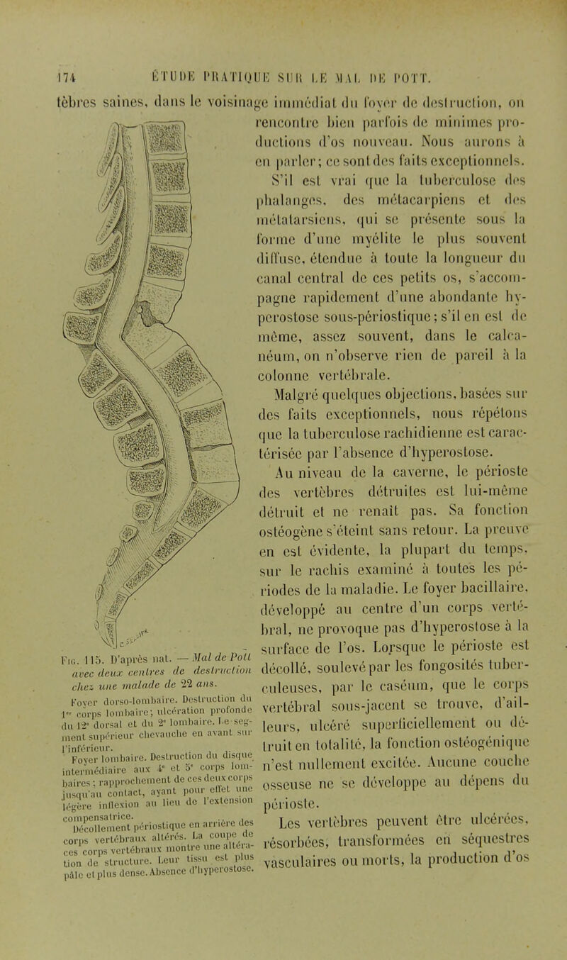 tèbres saines, dans le voisinage immédiat du foyér de deslruction, on rencontre bien parfois de minimes pro- ductions d'os nouveau. Nous aurons à en parler; ce soi il des faits exceptionnels. S'il est vrai que la tuberculose des phalanges, des métacarpiens et «les métatarsiens, qui se présente sous la forme d'une myélite le pins souvent dill'use, étendue à toute la longueur du canal central de ces petits os, s'accom- pagne rapidement d'une abondante hy- perostose sous-périostique ; s'il en est de même, assez souvent, dans le calca- néum, on n'observe rien de pareil à la colonne vertébrale. Malgré quelques objections, basées sur des faits exceptionnels, nous répétons que la tuberculose rachidienne est carac- térisée par l'absence d'hyperostose. Au niveau de la caverne, le périoste des vertèbres détruites est lui-même détruit et ne renaît pas. Sa fonction ostéogène s'éteint sans retour. La preuve en est évidente, la plupart du temps, sur le rachis examiné à toutes les pé- riodes de la maladie. Le foyer bacillaire, développé au centre d'un corps verté- bral, ne provoque pas d'hyperostose à la surface de l'os. Lorsque le périoste est décollé, soulevé par les fongosités tuber- culeuses, par le casëum, que le corps vertébral sous-jacent se trouve, d'ail- leurs, ulcéré superficiellement ou dé- truit en totalité, la fonction ostéogénique 'JZ^^T^J^Iiïi n'est nullement excitée. Aucune couche «î'^^^^o^X^um osseuse ne se développe an dépens du jusqu .in contact, iiy.mi. p . légère inflexion an lieu de I extension p£noste. compensatrice. , i&rfi dM Le§ vcr^brcS peuvent Ôtl'C ulcérées, résorbées, transformées en séquestres Fig. 115. D'après nat. — Mal de Poil avec deux centres 'le destruction chez une malade de 22 ans. Foyer dorso-lombaire. Destruction du l corps lombaire; ulcération profonde du i->. dorsal et du 2' lombaire, le seg- ment supérieur chevauche en avant sur Décollement périostique en arrière des corps vertébraux altérés. La poupe de ces corps vertébraux mofatre une altéra- Uon de structure. Leur tissu est plus vasculajres 0U UlOrlS, la production d OS pàlc cl plus dense. Absence à* l.yperostose.