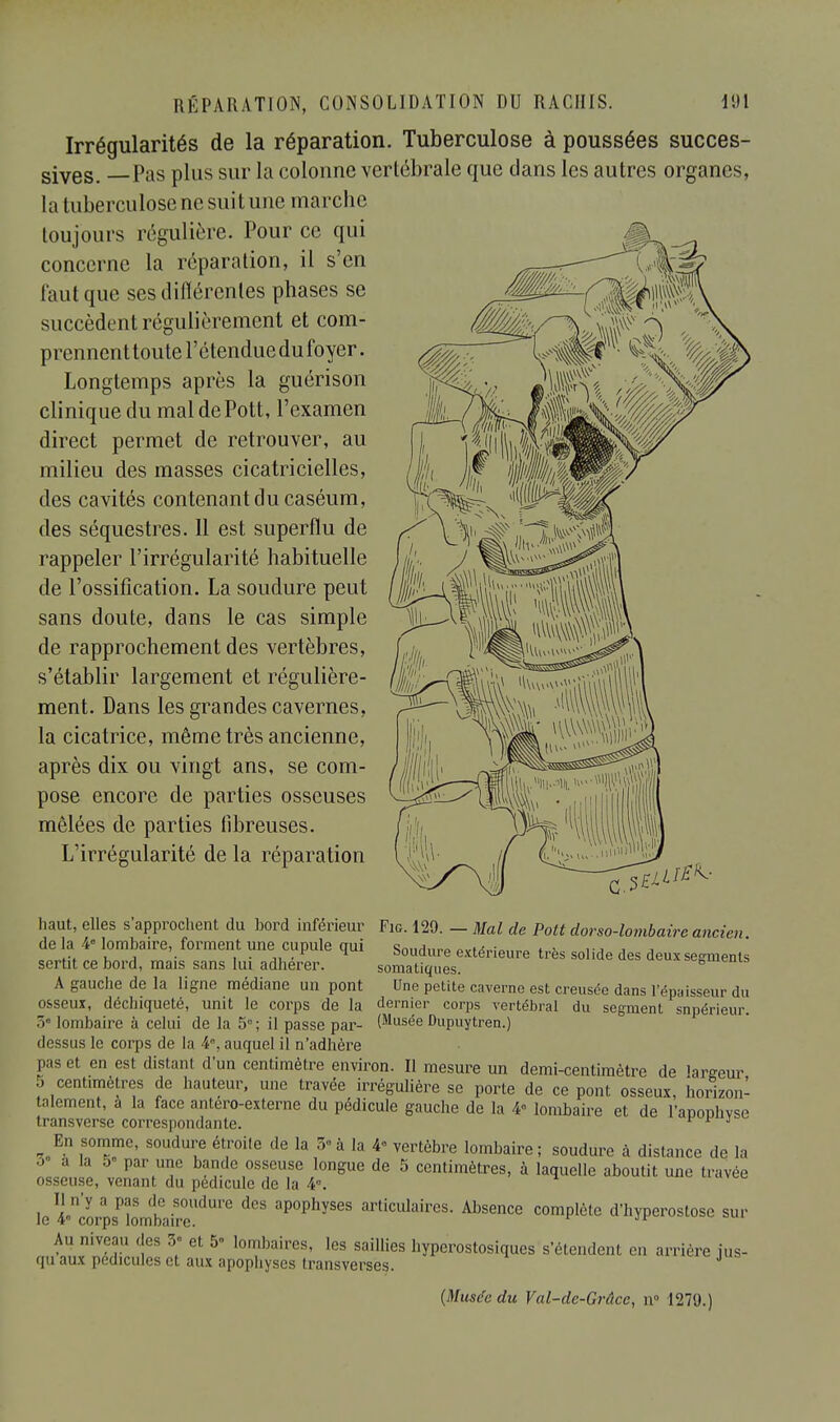 Irrégularités de la réparation. Tuberculose à poussées succes- sives. Pas plus sur la colonne vertébrale que dans les autres organes, la tuberculose ne suit une marche toujours régulière. Pour ce qui concerne la réparation, il s'en faut que ses différentes phases se succèdent régulièrement et com- prennent toute l'étendue du foyer. Longtemps après la guérison clinique du mal dePott, l'examen direct permet de retrouver, au milieu des masses cicatricielles, des cavités contenant du caséum, des séquestres. Il est superflu de rappeler l'irrégularité habituelle de l'ossification. La soudure peut sans doute, dans le cas simple de rapprochement des vertèbres, s'établir largement et régulière- ment. Dans les grandes cavernes, la cicatrice, même très ancienne, après dix ou vingt ans, se com- pose encore de parties osseuses mêlées de parties fibreuses. L'irrégularité de la réparation haut, elles s'approchent du bord inférieur de la 4° lombaire, forment une cupule qui sertit ce bord, mais sans lui adhérer. A gauche de la ligne médiane un pont Fig. 129. —. Mal de Pott dorso-lombaire ancien. Soudure extérieure très solide des deux segments somatiques. Une petite caverne est creusée dans l'épaisseur du osseux, déchiqueté, unit le corps de la dernier corps vertébral du segment supérieur. lombaire à celui de la 5e; il passe par- (Musée Dupuytren.) dessus le corps de la 4°, auquel il n'adhère pas et en est distant d'un centimètre environ. Il mesure un demi-centimètre de largeur 5 centimètres de hauteur, une travée irrégulière se porte de ce pont osseux, horizon- talement, à la face antero-exteme du pédicule gauche de la ¥ lombaire et de l'aponhvse transverse correspondante. v r i _ En somme, soudure étroite de la 5«à la 4» vertèbre lombaire; soudure à distance de la •> à la 5« par une bande osseuse longue de 5 centimètres, à laquelle aboutit une travée osseuse, venant du pédicule de la 4°. Il n'y a pas de soudure des apophyses articulaires. Absence complète d'hyperostose sur le 4° corps lombaire. Au niveau des 3° et 5° lombaires, les saillies hyperostosiques s'étendent en arrière jus- qu aux pédicules et aux apophyses transverses.