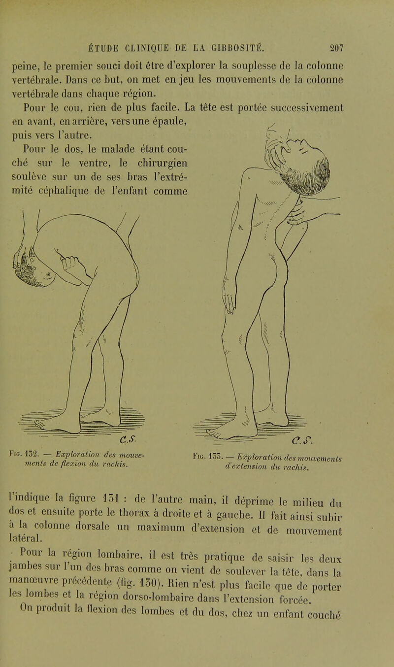 peine, le premier souci doit être d'explorer la souplesse de la colonne vertébrale. Dans ce but, on met en jeu les mouvements de la colonne vertébrale dans chaque région. Pour le cou, rien de plus facile. La tête est portée successivement en avant, en arrière, vers une épaule, , puis vers l'autre. V. s / Pour le dos, le malade étant cou- ^ ché sur le ventre, le chirurgien soulève sur un de ses bras l'extré- mité céphalique de l'enfant comme Fig. 132. — Exploration des mouve- ments de flexion du rachis. Cf. Fig. 155. — Exploration des mouvements d'extension du rachis. l'indique la figure loi : de l'autre main, il déprime le milieu du dos et ensuite porte le thorax à droite et à gauche. Il fait ainsi subir à la colonne dorsale un maximum d'extension et de mouvement latéral. Pour la région lombaire, il est très pratique de saisir les deux jambes sur l'un des bras comme on vient de soulever la tète, dans la manœuvre précédente (fig. 130). Rien n'est plus facile que de porter !. s lombes et la région dorso-lombaire dans l'extension forcée On produit la flexion des lombes et du dos, chez un enfant couché