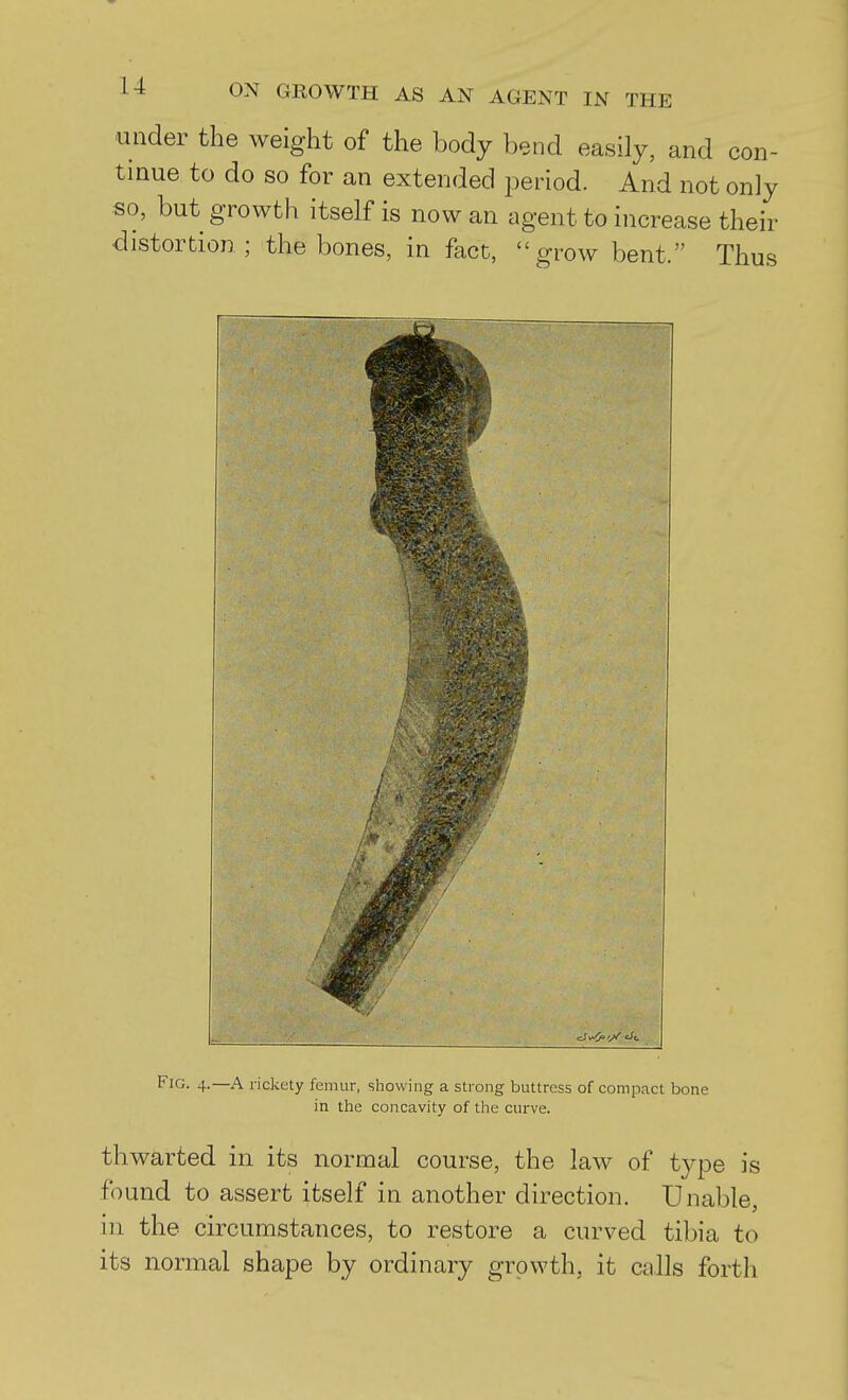 under the weight of the body bend easily, and con- tinue to do so for an extended j^eriod. And not only so, but growth itself is now an agent to increase their distortion; the bones, in fact, grow bent. Thus Fig. 4.—A rickety femur, showing a strong buttress of compact bone in the concavity of the curve. thwarted in its normal course, the law of type is found to assert itself in another direction. Unable, in the circumstances, to restore a curved tibia to its normal shape by ordinary growth, it calls forth