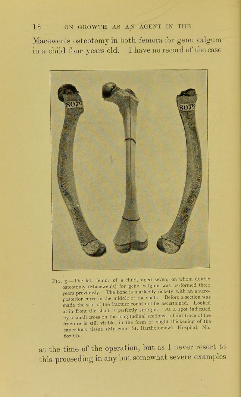 Macewen's osteotomy in both femora for genu valgum in a child four years old. I have no record of the case Fig. 5.—The left femur of a child, aged seven, on whom double osteotomy (Macewen's) for genu valgum was performed three years previously. The bone is markedly rickety, with an antero- posterior curve in the middle of the shaft. Before a section was made the seat of the fracture could not be ascertained. Looked at in front the shaft is perfectly straight. At a spot indicated by a small cross on the longitudinal sections, a faint trace of the fracture is still visible, in the form of slight thickening of the cancellous tissue (iMuseum, St. Bartholomew's Hospital, No. 807 G). at the time of the operation, but as I never resort to this proceeding in any but somewhat severe examples