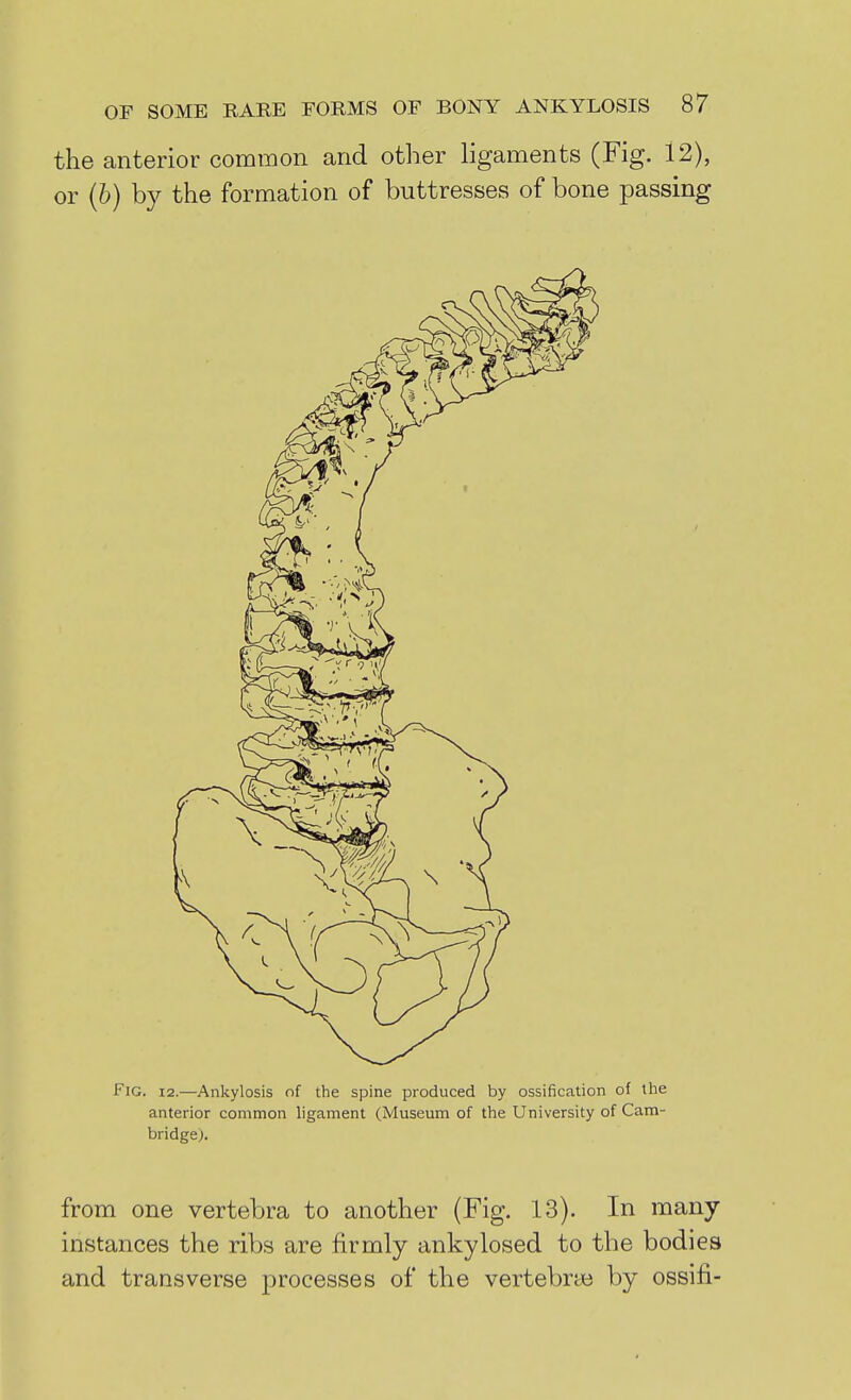 the anterior common and other hgaments (Fig. 12), or (6) by the formation of buttresses of bone passing from one vertebra to another (Fig. 13). In many instances the ribs are firmly ankylosed to the bodies and transverse processes of the vertebne by ossifi-