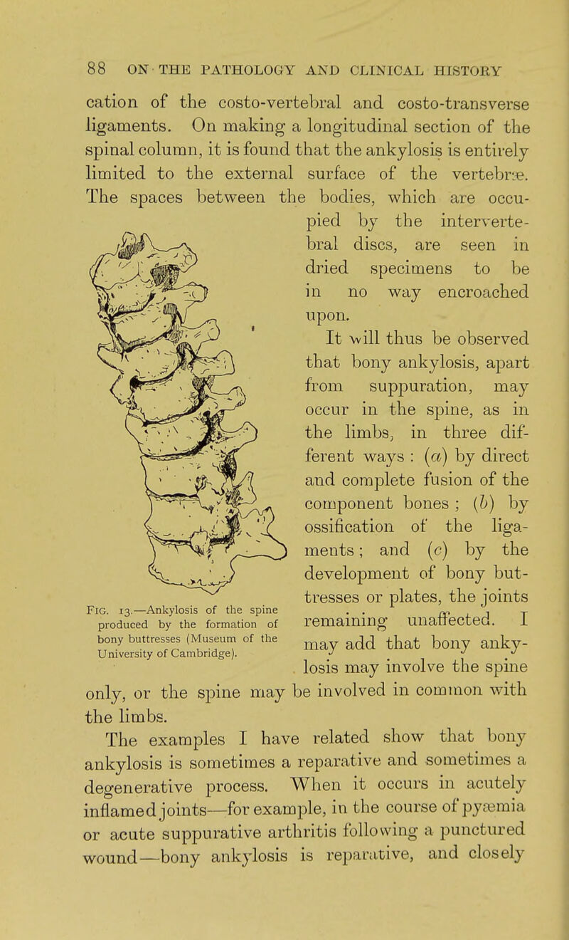 cation of the costo-vertebral and costo-transverse ligaments. On making a longitudinal section of the spinal column, it is found that the ankylosis is entirely limited to the external surface of the vertebrje. The spaces between the bodies, which are occu- pied by the interverte- bral discs, are seen in dried specimens to be in no way encroached upon. It \vill thus be observed that bony ankylosis, apart from suppuration, may occur in the spine, as in the limbs, in three dif- ferent ways : (co) hj direct and complete fusion of the component bones ; (b) by ossification of the liga- ments ; and (c) by the development of bony but- tresses or plates, the joints remaining unaffected. I may add that bony anky- losis may involve the spine only, or the spine may be involved in common with the limbs. The examples I have related show that bony ankylosis is sometimes a reparative and sometimes a degenerative process. When it occurs in acutely inflamed joints—for example, in the course of pyremia or acute suppurative arthritis following a punctured wound—bony ankylosis is reparative, and closely Fig. 13.—Ankylosis of the spine produced by the formation of bony buttresses (Museum of the University of Cambridge).