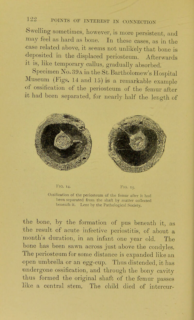 dwelling sometimes, however, is more persistent, and may feel as hard as bone. In these cases, as in the >case related above, it seems not unlikely that bone is deposited in the displaced periosteum. Afterwards it is, like temporary callus, gradually absorbed. Specimen No. 39a in the St.Bartholomew's Hospital Museum (Figs. 14 and 15) is a remarkable example of ossification of the periosteum of the femur after it had been separated, for nearly half the length of Fig. 14. Fig. ^5- Ossification of the periosteum of the femur after it had been separated from the shaft by matter collected beneath it. Lent by the Pathological Society. the bone, by the formation of pus beneath it, as the result of acute infective periostitis, of about a month's duration, in an infant one year old. The bone has been sawn across just above the condyles. The periosteum for some distance is expanded like an ■open umbrella or an egg-cup. Thus distended, it has undergone ossification, and through the bony cavity thus formed the original shaft of the femur passes h'ke a central stem, The child died of intercur-