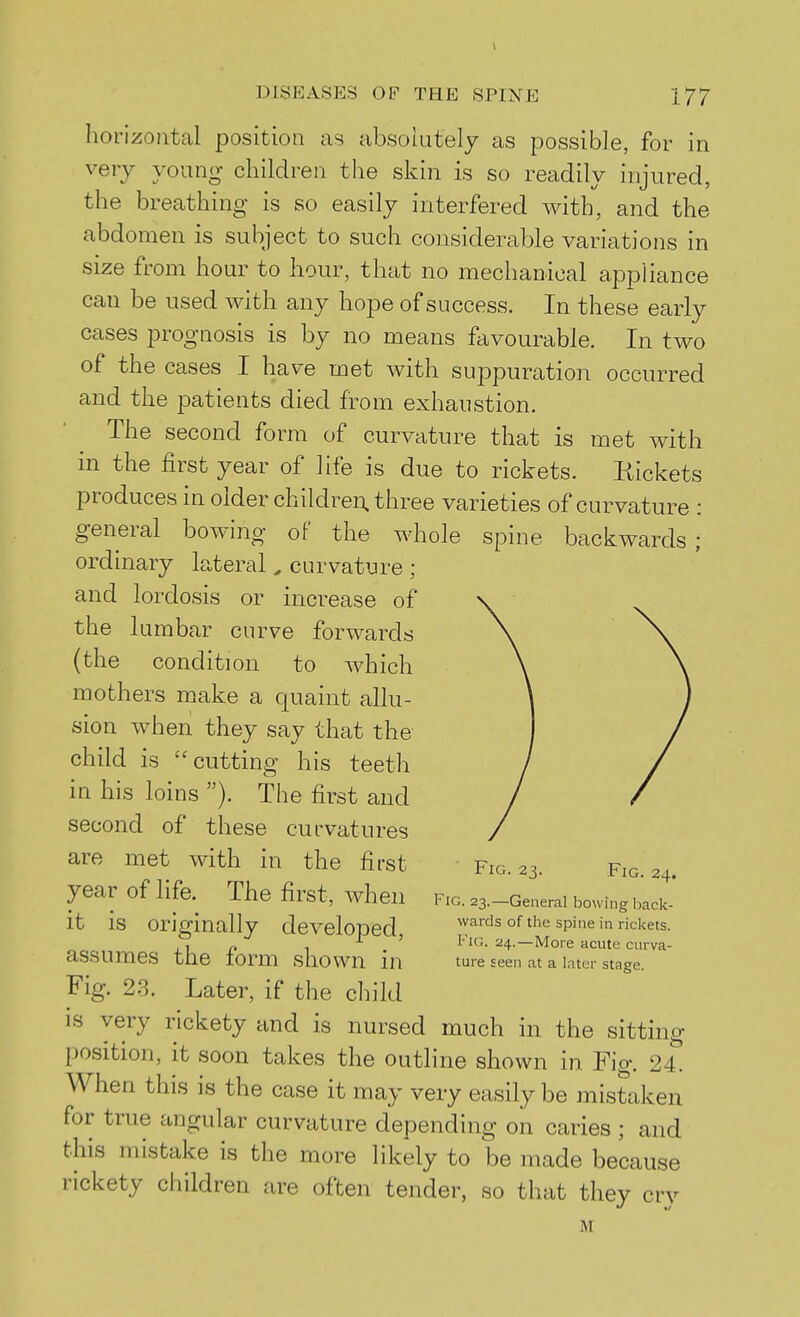 horizontal position as absolutely as possible, for in very young children the skin is so readily injured, the breathing- is so easily interfered with, and the abdomen is subject to such considerable variations in size from hour to hour, that no mechanical appliance can be used with any hope of success. In these early cases prognosis is by no means favourable. In two of the cases I have met with suppuration occurred and the patients died from exhaustion. The second form of curvature that is met with in the first year of life is due to rickets. Kickets produces in older children, three varieties of curvature : general bowing of the whole spine backwards; ordinary lateral , curvatvire ; and lordosis or increase of the lumbar curve forwards (the condition to which mothers make a quaint allu- sion when they say that the child is cutting his teeth in his loins ). The first and second of these curvatures are met with in the first Fig. 23. Fig. 24. year of life. The first, when fig. ^a.-Generai bowing back * it is originally developed wards of the spine in rickets. ,] r. 1 -t^ ' Fig. 24.—More acute curva- aSSUmeS the lorm shown m ture seen at a later stage. Fig. 23. Later, if the child is very rickety and is nursed much in the sitting position, it soon takes the outline shown in Fig. 24. When this is the case it may very easily be mistaken for true angular curvature depending on caries ; and this mistake is the more likely to be made because rickety children are often tender, so that they cry M