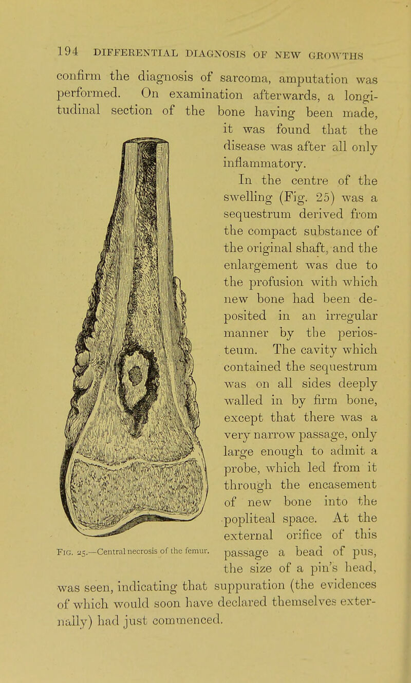 confirm the diagnosis of sarcoma, amputation was performed. On examination afterwards, a longi- tudinal section of the bone having been made, it was found that the disease was after all only inflammatory. In the centre of the swelling (Fig. 25) was a sequestrum derived from the compact substance of the original shaft, and the enlargement was due to the profusion with which new bone had been de- posited in an irregular manner by the perios- teum. The cavity which contained the sequestrum was on all sides deeply walled in by firm bone, except that there was a very narrow passage, onl}^ large enough to admit a probe, which led from it through the encasement of new bone into the popliteal space. At the external orifice of this Fig. i!5.—Central necrosis of the femur. paSSagO a bead of pUS, the size of a pin's head, was seen, indicating that suppuration (the evidences of which would soon have declared themselves exter- nally) had just commenced.