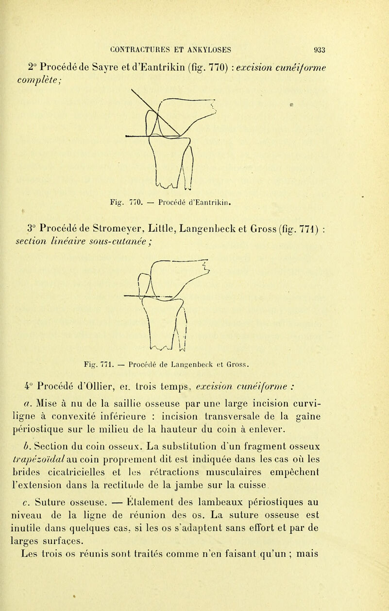 2° Procédé de Sayre et d'Eantrikin (fig. 770) : excision cunéiforme complète; Fig. 770. — Procédé d'Eantrikin. 3° Procédé de Stromeyer, Litlle, Langenbeck et Gross (fig. 771) : section linéaire sous-cutanée ; 4° Procédé d'Ollier, ei. trois temps, excision cunéiforme : a. Mise à nu de la saillie osseuse par une large incision curvi- ligne à convexité inférieure : incision transversale de la gaine périostique sur le milieu de la hauteur du coin à enlever. b. Section du coin osseux. La substitution d'un fragment osseux trapézoïdal au coin proprement dit est indiquée dans les cas où les brides cicatricielles et lus rétractions musculaires empêchent l'extension dans la rectitude de la jambe sur la cuisse. c. Suture osseuse. — Etalement des lambeaux périostiques au niveau de la ligne de réunion des os. La suture osseuse est inutile dans quelques cas. si les os s'adaptent sans effort et par de larges surfaces. Les trois os réunis sont traités comme n'en faisant qu'un ; mais