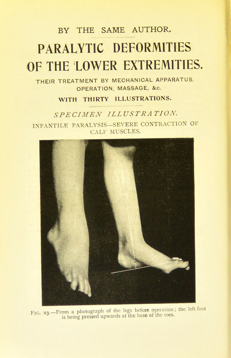 PARALYTIC DEFORMITIES OF THE LOWER EXTREMITIES. THEIR TREATMENT BY MECHANICAL APPARATUS, OPERATION, MASSAGE, &c. WITH THIRTY ILLUSTRATIONS. SPECIMEN ILLUSTRATION. INFANTILE PARALYSIS—SEVERE CONTRACTION OF CALF MUSCLES.