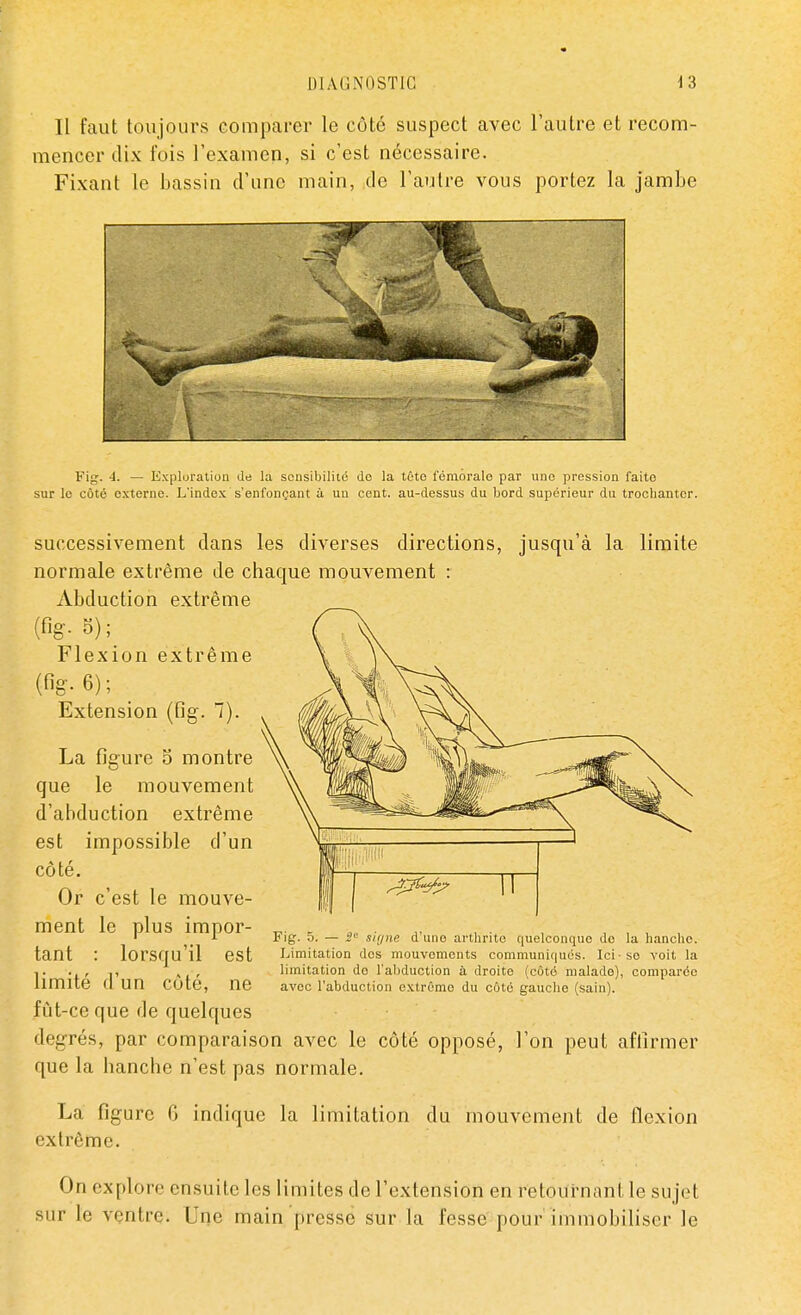 Il faut toujours comparer le côté suspect avec l'autre et recom- mencer dix fois l'examen, si c'est nécessaire. Fixant le bassin d'une main, de l'autre vous portez la jambe 3r Fig. 4. — Exploration de la sensibilité do la tôto fémorale par une pression faite sur le côté externe. L'index s'enfonçant à un cent, au-dessus du bord supérieur du trochanter. successivement dans les diverses directions, jusqu'à la limite normale extrême de chaque mouvement : Abduction extrême (%• B);e Flexion extrême (fig- 6); Extension (fig. 1). La figure 5 montre que le mouvement d'abduction extrême est impossible d'un côté. Or c'est le mouve- ment le plus impor- ' _ 1 I)ig. 5. — 5° signe duno arthrite quelconque do la hanche, tant : lorsqu'il est Limitation dos mouvements communiqués. Iciso voit la t., -p ,limitation do l'abduction à droite (côté malade), comparée limité fl Un Coté, ne avec l'abduction extrême du côté gauche (sain). fût-ce que de quelques degrés, par comparaison avec le côté opposé, l'on peut affirmer que la hanche n'est pas normale. La figure 6 indique la limitation du mouvement de flexion extrême. On cxploie ensuite les limites de l'extension en retournant le sujet sur le ventre. Une main presse sur la fesse pour immobiliser le