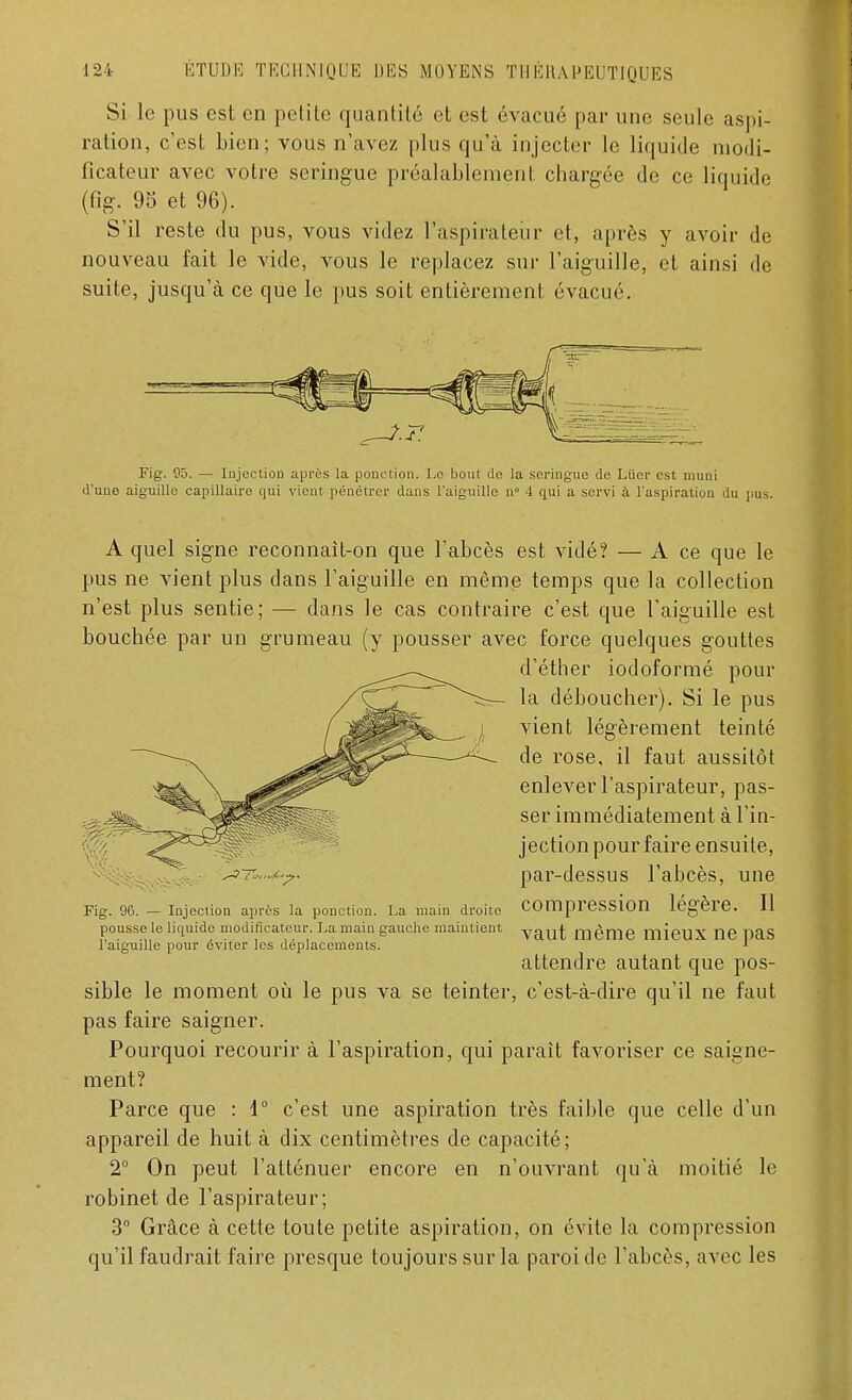 Si le pus est en petite quantité et est évacué par une seule aspi- ration, c'est bien; vous n'avez plus qu'à injecter le liquide modi- ficateur avec votre seringue préalablemenl. chargée de ce liquide (fig. 95 et 96). S'il reste du pus, vous videz l'aspirateur et, après y avoir de nouveau fait le vide, vous le replacez sur l'aiguille, et ainsi de suite, jusqu'à ce que le pus soit entièrement évacué. Fig. 95. — Injection après la ponction. Le bout de la seringue de Luer est muni d'une aiguille capillaire qui vient pénétrer dans l'aiguille n° 4 qui a servi à l'aspiration du pus. A quel signe reconnaît-on que l'abcès est vidé? — A ce que le pus ne vient plus dans l'aiguille en même temps que la collection n'est plus sentie; — dans le cas contraire c'est que l'aiguille est bouchée par un grumeau (y pousser avec force quelques gouttes d'éther iodoformé pour la déboucher). Si le pus vient légèrement teinté de rose, il faut aussitôt enlever l'aspirateur, pas- ser immédiatement à l'in- jection pour faire ensuite, par-dessus l'abcès, une Fig. 96. — Injection après la ponction. La main droite Compression légère. Il pousse le liquide modificateur. La main gauche maintient yailt même mieUX lie pas l'aiguille pour éviter les déplacements. ' * attendre autant que pos- sible le moment où le pus va se teinter, c'est-à-dire qu'il ne faut pas faire saigner. Pourquoi recourir à l'aspiration, qui parait favoriser ce saigne- ment? Parce que : 1° c'est une aspiration très faible que celle d'un appareil de huit à dix centimètres de capacité; 2° On peut l'atténuer encore en n'ouvrant qu'à moitié le robinet de l'aspirateur; 3° Grâce à cette toute petite aspiration, on évite la compression qu'il faudrait faire presque toujours sur la paroi de l'abcès, avec les