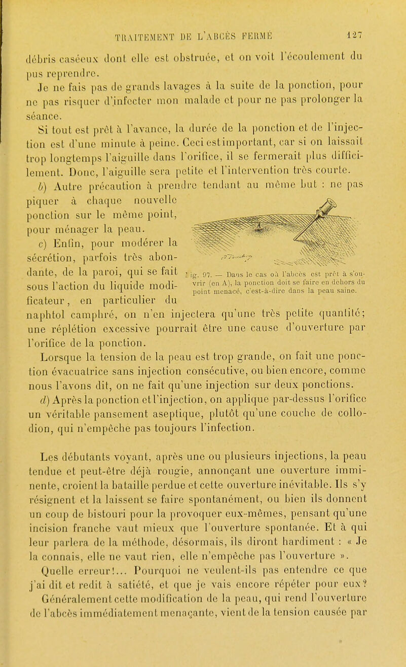 débris caséeux dont elle esL obstruée, et on voit l'écoulement du pus reprendre. Je ne fais pas de grands lavages à la suite de la ponction, pour ne pas risquer d'infecter mon malade et pour ne pas prolonger la séance. Si tout est prêt à l'avance, la durée de la ponction et de l'injec- tion est d'une minute à peine. Ceci estimportant, car si on laissait trop longtemps l'aiguille dans l'orifice, il se fermerait plus diffici- lement. Donc, l'aiguille sera petite et l'intervention très courte. b) Autre précaution à prendre tendant au môme but : ne pas piquer à chaque nouvelle ponction sur le même point, pour ménager la peau. c) Enfin, pour modérer la sécrétion, parfois très abon- dante, de la paroi, qui se fait sous l'action du liquide modi- ficateur , en particulier du naphtol camphré, on n'en injectera qu'une très petite quantité; une réplétion excessive pourrait être une cause d'ouverture par l'orifice de la ponction. Lorsque la tension de la peau est trop grande, on fait une ponc- tion évacuatrice sans injection consécutive, ou bien encore, comme nous l'avons dit, on ne fait qu'une injection sur deux ponctions. d) Après la ponction etl'injection, on applique par-dessus l'orifice un véritable pansement aseptique, plutôt qu'une couche de collo- dion, qui n'empêche pas toujours l'infection. jg. 97. — Dans le cas où l'abcès est prêt à s'ou- vrir (on A), la ponction doit se l'aire en dehors du point menacé, c'est-à-dire dans la peau saine. Les débutants voyant, après une ou plusieurs injections, la peau tendue et peut-être déjà rougïe, annonçant une ouverture immi- nente, croient la bataille perdue et cette ouverture inévitable. Ils s'y résignent et la laissent se faire spontanément, ou bien ils donnent un coup de bistouri pour la provoquer eux-mêmes, pensant qu'une incision franche vaut mieux que l'ouverture spontanée. Et à qui leur parlera de la méthode, désormais, ils diront hardiment : « Je la connais, elle ne vaut rien, elle n'empêche pas l'ouverture ». Quelle erreur!... Pourquoi ne veulent-ils pas entendre ce que j'ai dit et redit à satiété, et que je vais encore répéter pour eux? Généralement cette modification de la peau, qui rend l'ouverture de l'abcès immédiatement menaçante, vient de la tension causée par