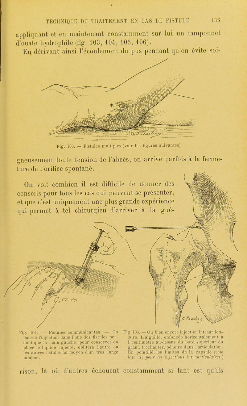 appliquant et en maintenant constamment sur lui un tamponnet d'ouate hydrophile (fïg. 103, 104, 105, 106). En dérivant ainsi l'écoulement du pus pendant qu'on évite soi- Fig. 103. — Fistules multiples (voir les figures suivantes). gneusement toute tension de l'abcès, on arrive parfois à la ferme- ture de l'orifice spontané. On voit combien il est difficile de donner des conseils pour tous les cas qui peuvent se présenter, et que c'est uniquement une plus grande expérience qui permet à tel chirurgien d'arriver à la gué- pig, in). _ Fistules communicantes. — On Fig.105.— Ou bien encoreinjectionintraarticu- pousso l'injoction clans l'une des fistules pen- laire. L'aiguille, enfoncée horizontalement à clant que la main <_r.'uicho, pour conserver on 1 centimètre au-dessus du bord supérieur du place le liquide injecté, oblitère l'autre ou grand trochanter, pônôtro dans l'articulation, les autres fistules au moyen d'un 1res large En pointillé, les limites do la capsule {voie tampon. latérale pour 1rs injections intraarticulaires.) rison, là où d'autres échouent constamment si tant est qu'ils