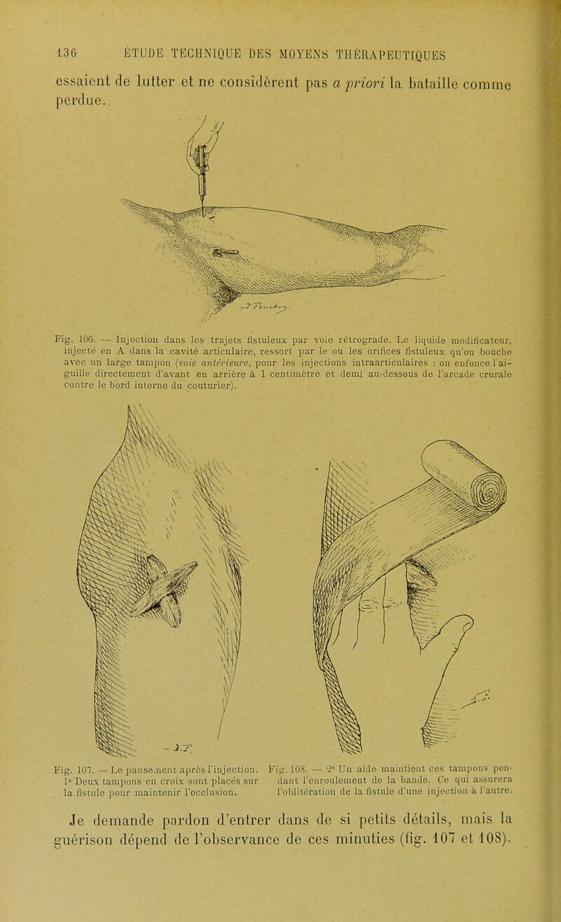 essaient de lutter et ne considèrent pas a priori la bataille comme perdue. Fig. 106. — Injection dans les trajets fistuleux par voie rétrograde. Le liquide modilicatcur, injecté en A dans la cavité articulaire, ressort par le ou les orifices fistuleux qu'on bouche avec un large tampon (voie antérieure, pour les injections intraarticulaires : on enfonce l'ai- guille directement d'avant en arrière à 1 centimètre et demi au-dessous de l'arcade crurale contre le bord interne du couturier). Fig. loi. — Lo panse.nent après l'injection. Fig. 108. — 2» Un aide maintient ces tampons pon- 1° Deux tampons en croix sont placés sur dant l'enroulement do la bande. Ce qui assurera la fistule pour maintenir l'occlusion. l'oblitération de la fistule d'une injection à l'autre. Je demande pardon d'entrer dans de si petits détails, mais la guérison dépend de l'observance de ces minuties (fig. 107 et 108).