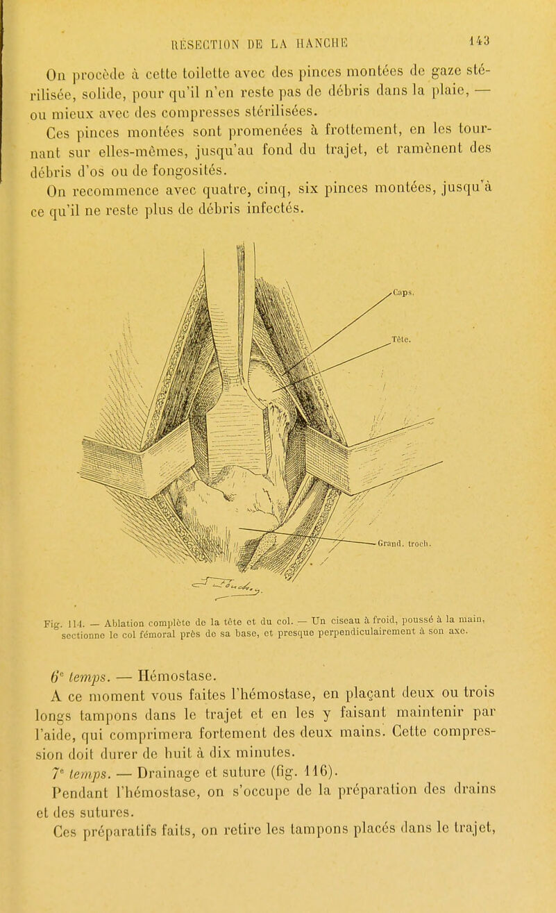 On procède à cotte toilette avec des pinces montées de gaze sté- rilisée, solide, pour qu'il n'en reste pas de débris dans la plaie, — ou mieux avec des compresses stérilisées. Ces pinces montées sont promenées à frottement, en les tour- nant sur elles-mêmes, jusqu'au fond du trajet, et ramènent des débris d'os ou de fongosités. On recommence avec quatre, cinq, six pinces montées, jusqu'à ce qu'il ne reste plus de débris infectés. Fig. 114. — Ablation complote de la tôte et du col. — Un ciseau à froid, poussé à la main, ° sectionne le col fémoral près do sa base, et presque perpendiculairement à son axe. 6'c temps. — Hémostase. A ce moment vous faites l'hémostase, en plaçant deux ou trois longs tampons dans le trajet et en les y faisant maintenir par l'aide, qui comprimera fortement des deux mains. Cette compres- sion doit durer de bu il à dix minutes. 7e temps. — Drainage et suture (fig. 116). Pendant l'hémostase, on s'occupe de la préparation des drains et des sutures. Ces préparatifs faits, on retire les tampons placés dans le trajet,