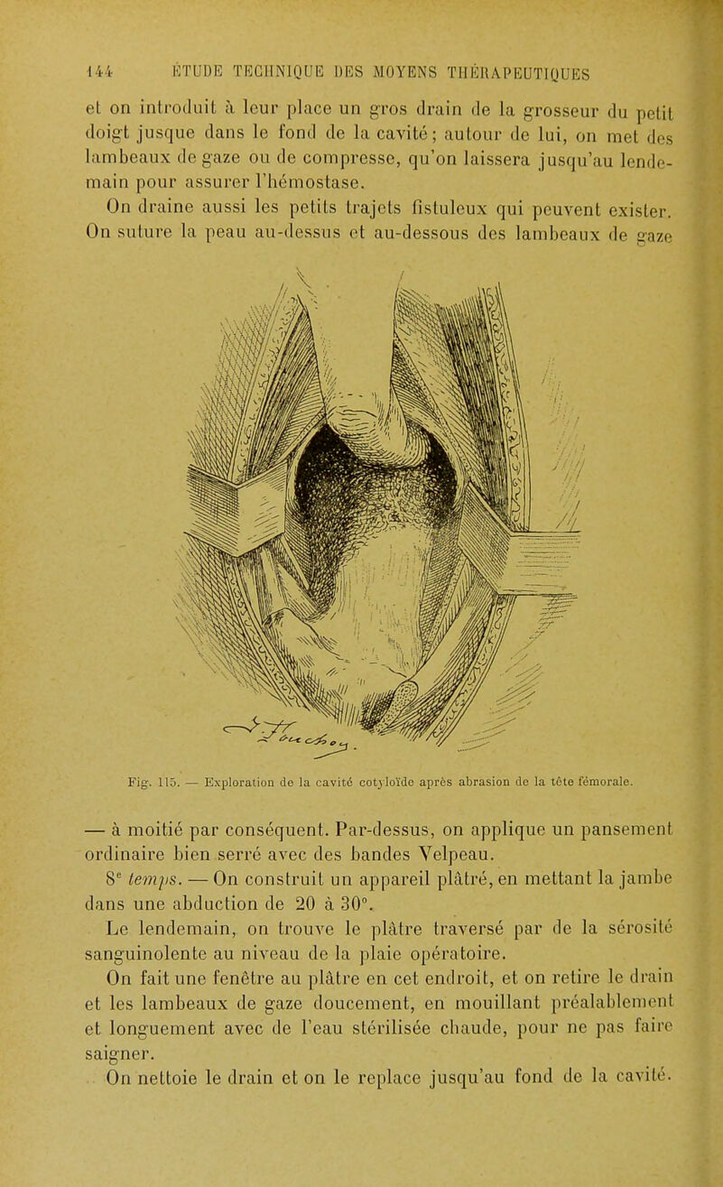 et on introduit à leur place un gros drain de la grosseur du petit doigt jusque dans le fond de la cavité; autour de lui, on met des lambeaux de gaze ou de compresse, qu'on laissera jusqu'au lende- main pour assurer l'hémostase. On draine aussi les petits trajets fistuleux qui peuvent exister. On suture la peau au-dessus et au-dessous des lambeaux de gaze Fig. 115. — Exploration de la cavité cotyloïdo après abrasion do la tète fémorale. — à moitié par conséquent. Par-dessus, on applique un pansement ordinaire bien serré avec des bandes Velpeau. 8e temps. — On construit un appareil plâtré, en mettant la jambe dans une abduction de 20 à 30°. Le lendemain, on trouve le plâtre traversé par de la sérosité sanguinolente au niveau de la plaie opératoire. On fait une fenêtre au plâtre en cet endroit, et on retire le drain et les lambeaux de gaze doucement, en mouillant préalablement et longuement avec de l'eau stérilisée chaude, pour ne pas faire saigner. On nettoie le drain et on le replace jusqu'au fond de la cavité.