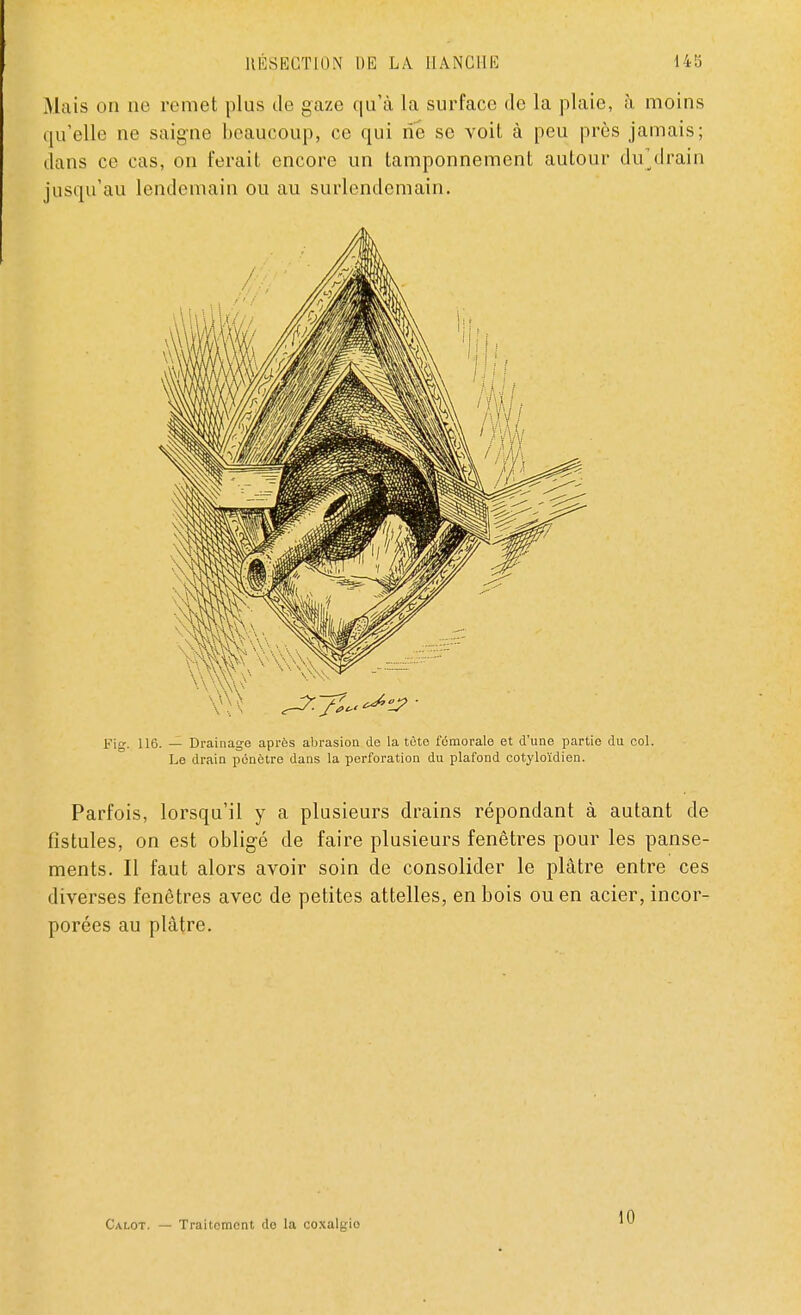 Mais on ne remet plus de gaze qu'à la surface de la plaie, à moins qu'elle ne saigne beaucoup, ce qui rie se voit à peu près jamais; dans ce cas, on ferait encore un tamponnement autour drf drain jusqu'au lendemain ou au surlendemain. Fig. 116. — Drainage après abrasion de la tète fémorale et d'une partie du col. Le drain pénètre dans la perforation du plafond cotyloïdien. Parfois, lorsqu'il y a plusieurs drains répondant à autant de fistules, on est obligé de faire plusieurs fenêtres pour les panse- ments. Il faut alors avoir soin de consolider le plâtre entre ces diverses fenêtres avec de petites attelles, en bois ou en acier, incor- porées au plâtre. Calot. — Traitement do la coxalgio II)
