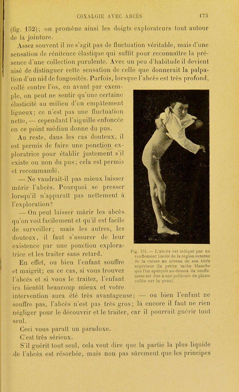 (fig, 152); on promène ainsi les doigts explorateurs tout autour île la jointure. Assez souvent il ne s'agit pas de fluctuation véritable, mais d'une sensation de rénitence élastique qui suffit pour reconnaître la pré- sence d'une collection purulente. Avec un peu d'habitude il devient aisé de distinguer celte sensation de celle que donnerait la palpa- tion d'un nid de fongosités. Parfois, lorsque l'abcès est très profond, collé contre l'os, en avant par exem- ple, on peut ne sentir qu'une certaine élasticité au milieu d'un empâtement ligneux; ce n'est pas une fluctuation nette, — cependant l'aiguille enfoncée en ce point médian donne du pus. Au reste, dans les cas douteux, il est permis de faire une ponction ex- ploratrice pour établir justement s'il existe ou non du pus; cela est permis et recommandé. — Ne vaudrait-il pas mieux laisser mûrir l'abcès. Pourquoi se presser lorsqu'il n'apparaît pas nettement à l'exploration? — On peut laisser mûrir les abcès qu'on voit facilement et qu'il est facile de surveiller; mais les autres, les douteux, il faut s'assurer de leur existence par une ponction explora- trice et les traiter sans retard. En effet, ou bien l'enfant souffre et maigrit; en ce cas, si vous trouvez l'abcès et si vous le traitez, l'enfant ira bientôt beaucoup mieux et votre intervention aura été très avantageuse; — ou bien l'enfant ne souffre pas, l'abcès n'est pas très gros; là encore il faut ne rien négliger pour le découvrir et le traiter, car il pourrait guérir tout seul. Ceci vous paraît un paradoxe. C'est très sérieux. S'il guérit tout seul, cela veut dire que la partie la plus liquide de l'abcès est résorbée, mais non pas sûrement que les principes Fig. 151.— L'abcès est indiqué par un renflement limité de la région externe do la cuisse au niveau de son tiers supérieur (la petite tache blanche que l'on aperçoit au-dessus du renfle- ment est due à une pellicule do plâtre collée sur la peau).