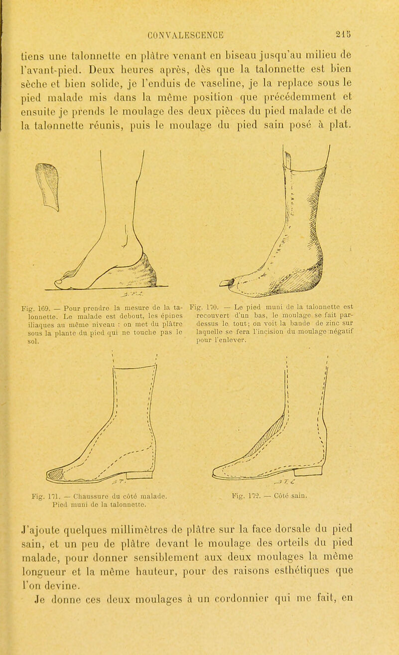 tiens une talonnette en plâtre venant en biseau jusqu'au milieu de l'avant-pied. Deux heures après, dès que la talonnette est bien sèche et bien solide, je l'enduis de vaseline, je la replace sous le pied malade mis dans la même position que précédemment et ensuite je prends le moulage des deux pièces du pied malade et de la talonnette réunis, puis le moulage du pied sain posé à plat. Fig. ni. — Cliaussuro du cotô malade. Fig. 172. — Coté sain. Pied muni de la talonnette. J'ajoute quelques millimètres de plâtre sur la face dorsale du pied sain, et un peu de plâtre devant le moulage des orteils du pied malade, pour donner sensiblement aux deux moulages la même longueur et la môme hauteur, pour des raisons esthétiques que l'on devine. Je donne ces deux moulages à un cordonnier qui me fait, en
