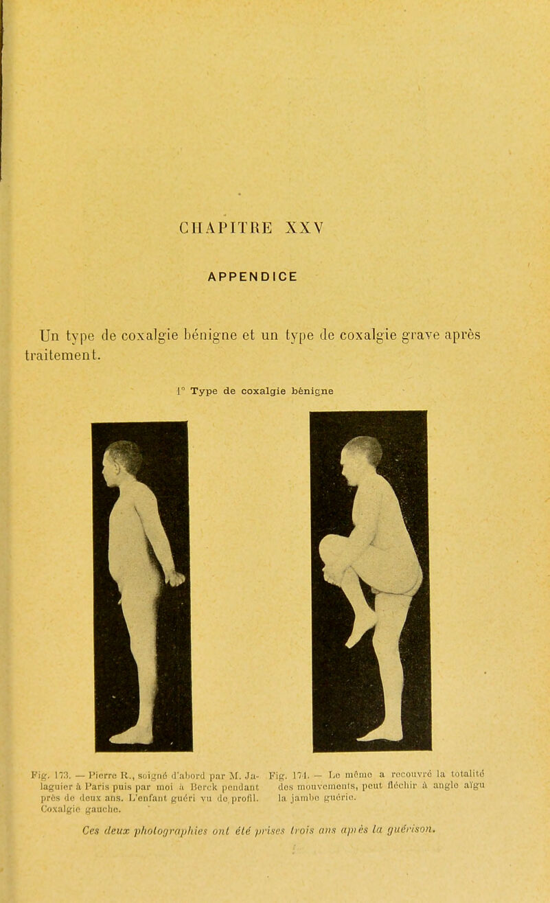 CHAPITRE XXV APPENDICE Un type de coxalgie bénigne et un type de coxalgie grave après traitement. 1° Type de coxalgie bénigne Fig, 173. — Pierre R., soigné d'abord par M. Ja- Fig. 174. - Le mémo a recouvré la totalité laguier à Paris puis par moi à Berck pendant des mouvements, peut fléchir à angle aïgu près de deux ans. L'enfant guéri vu de profil. la jambe guérie. Coxalgie gaucho. Ces deux ■photographies ont été prises trois ans apiès la guërison»