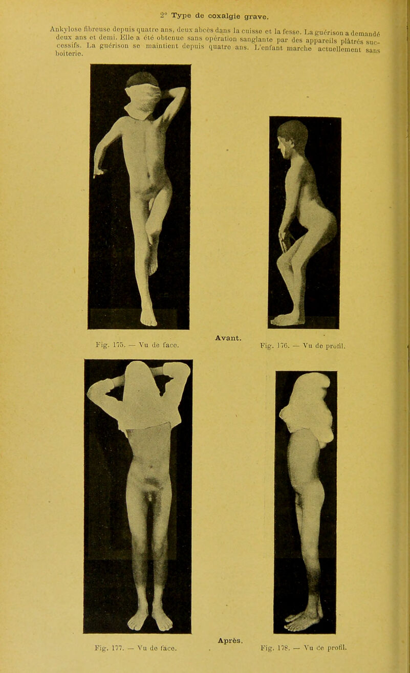 2° Type de coxalgie grave. Ankyloso fibreuse depuis quatre ans, deux abecs dans la cuisse et la fesse. La guérison a demandé deux ans et demi. Elle a été obtenue sans opération sanglante par des appareils plâtrés'sur cessas. La guérison se maintient depuis quatre ans. L'enfant marche actuellement sans lioitorio. Fi-. P35, Vu de l'ace. Avant. Fig. 116. — Vu de prurit. Fig. 117. — ii de l'ace. Après. Fig. U?. — Vu do profil.